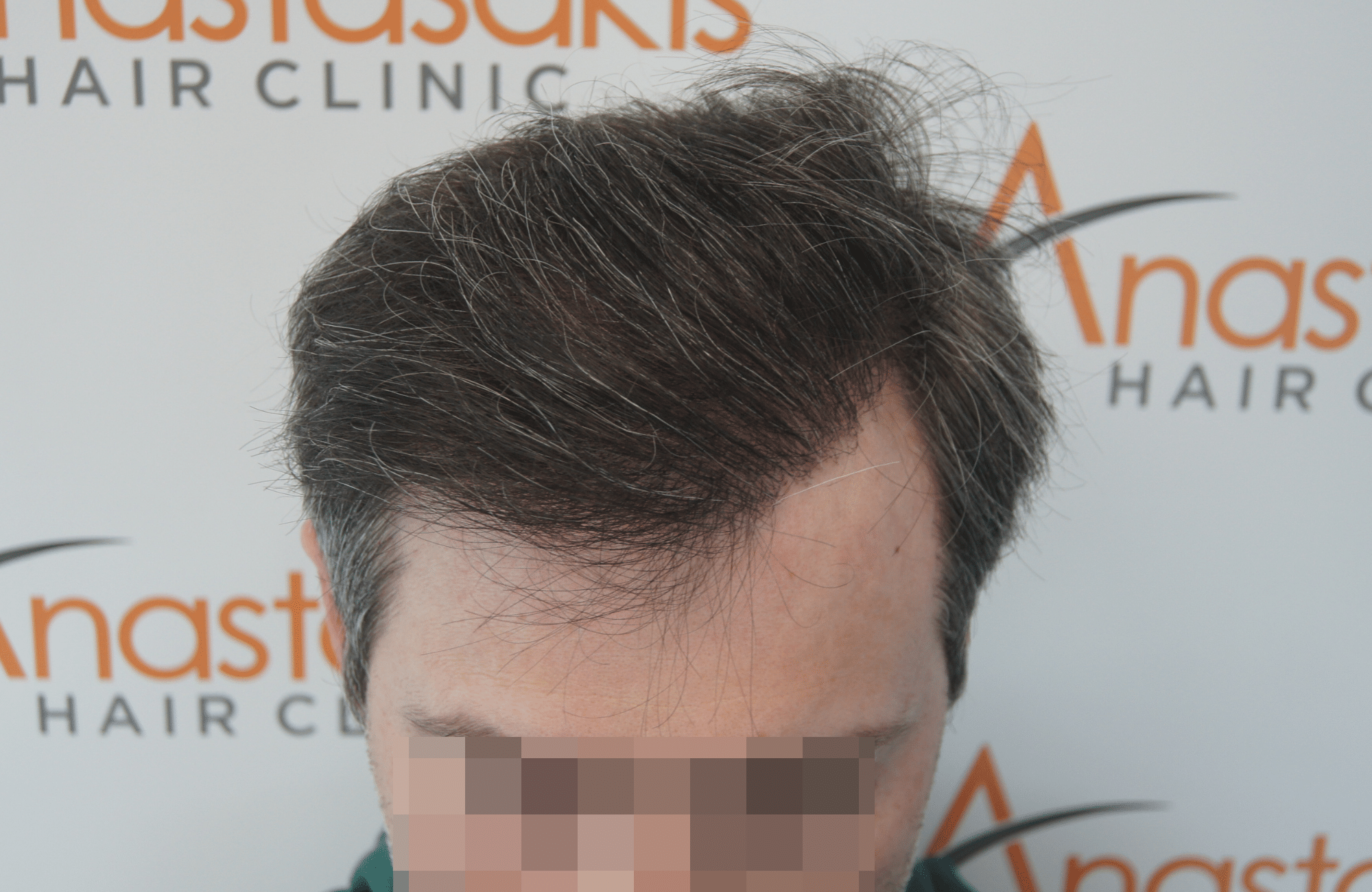 hair transplant result with 2500 follicular units anastasakis hair clinic