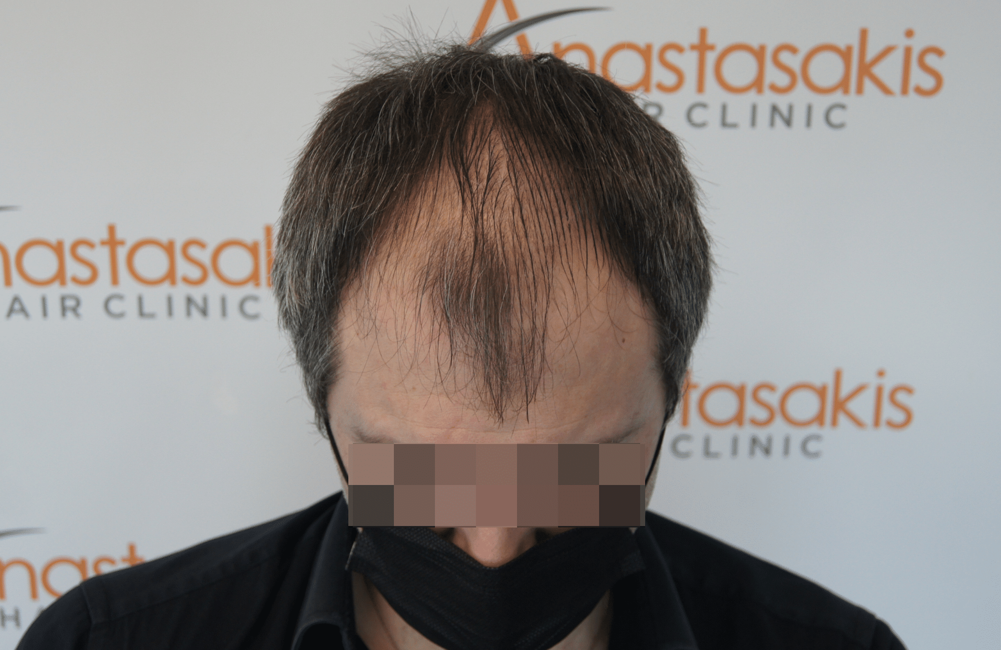hair transplant result with 2500 follicular units anastasakis hair clinic