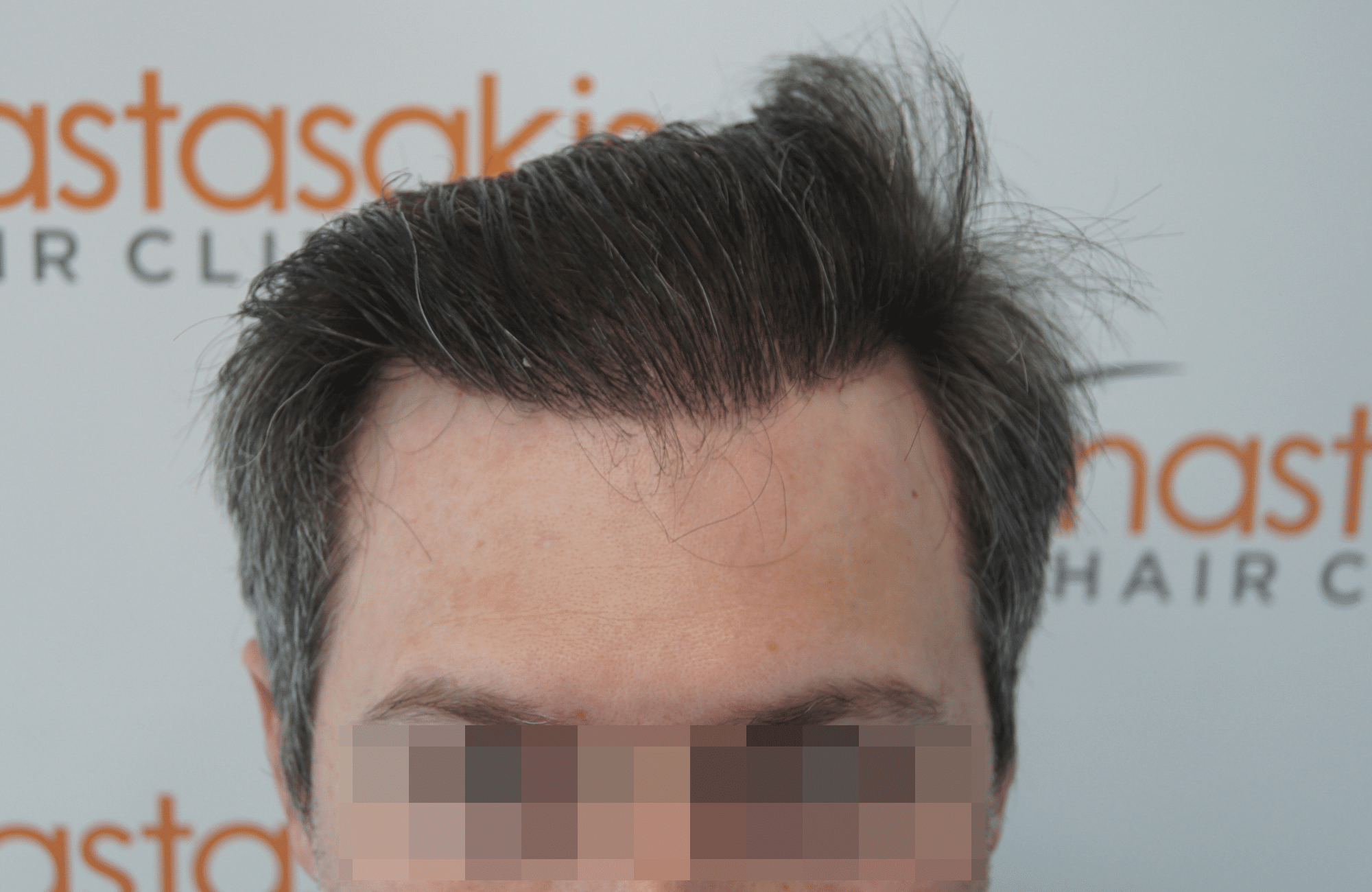 hair transplant result with 2500 follicular units anastasakis hair clinic