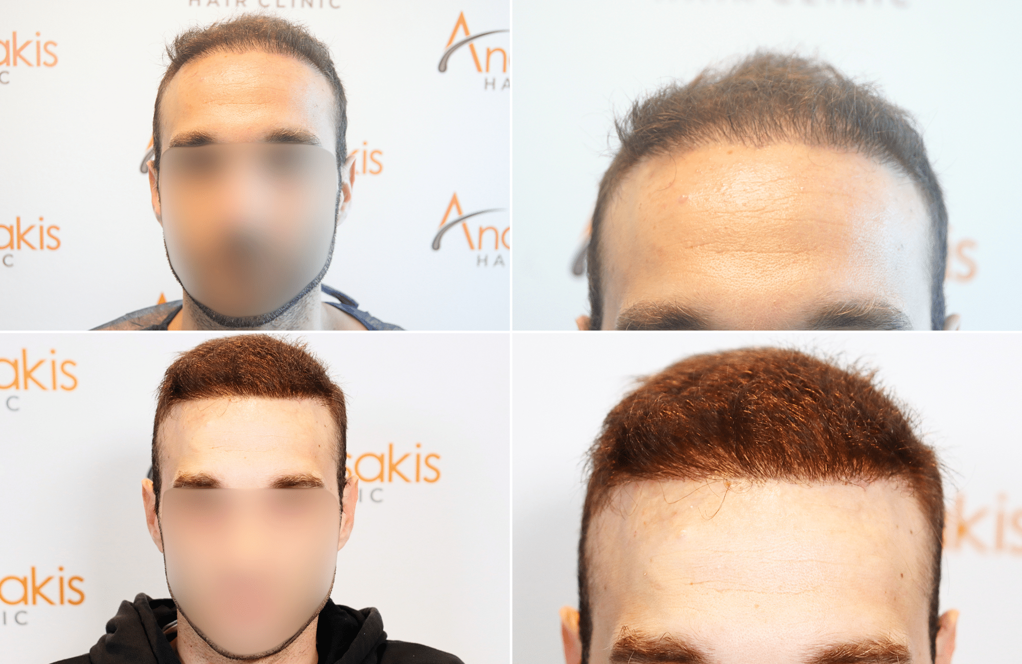 https://www.anastasakishairclinic.gr/portfolio/apotelesma-metamosxefsis-mallion-anastasakis-hair-clinic-37/