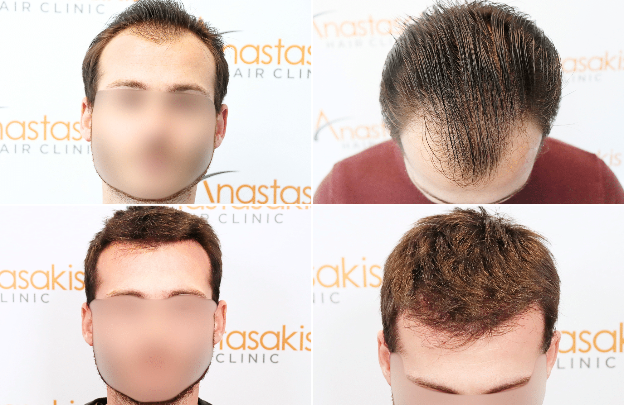 https://www.anastasakishairclinic.gr/portfolio/apotelesma-metamosxefsis-mallion-anastasakis-hair-clinic-162/