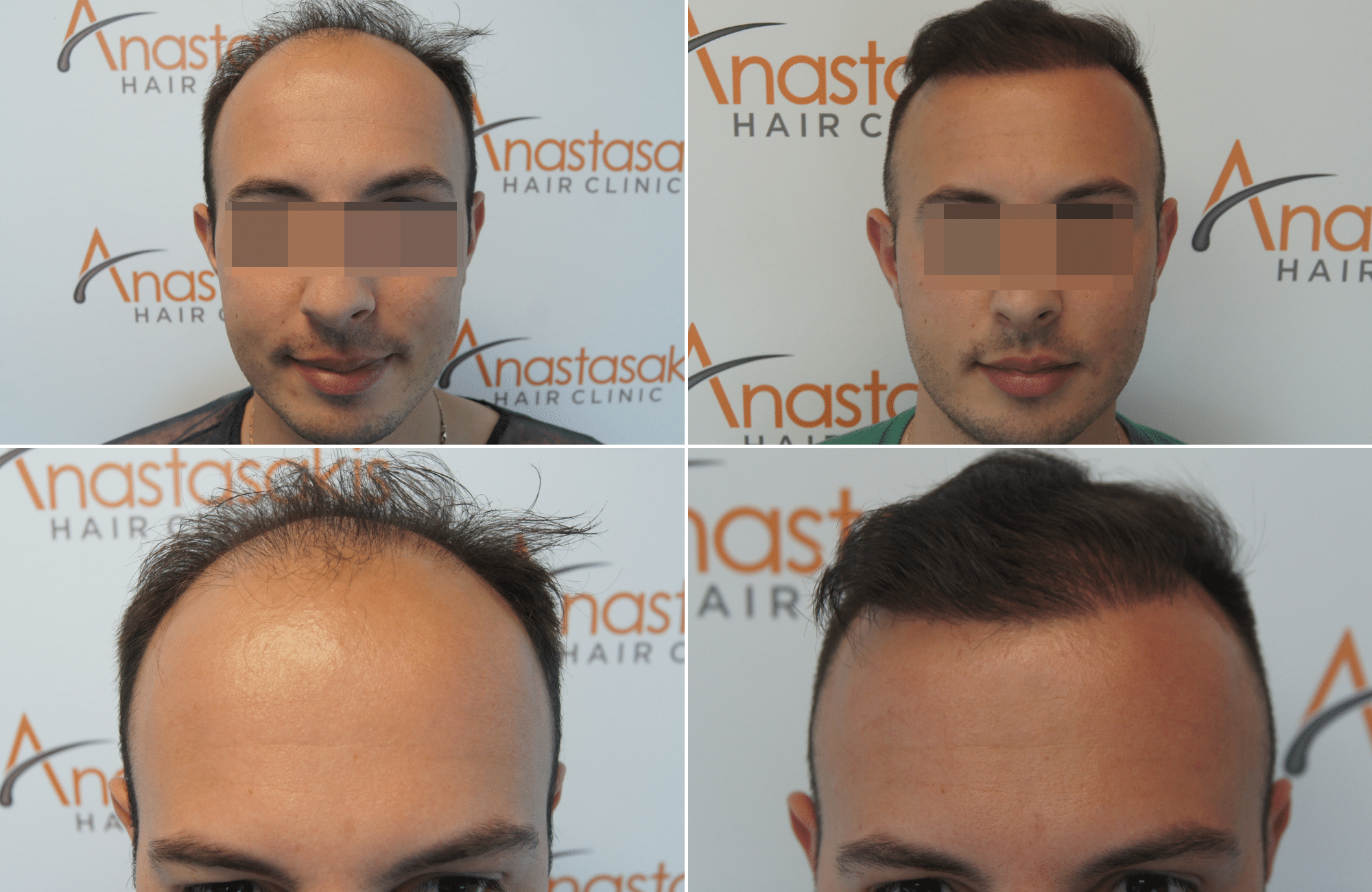 hair transplant result with 2500 follicular units anastasakis hair clinic