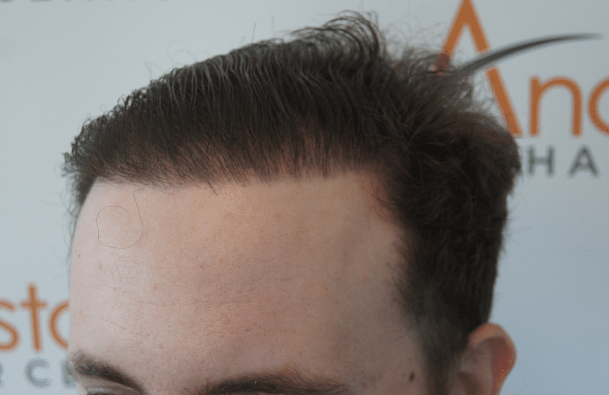 hair transplant result with 2500 follicular units anastasakis hair clinic