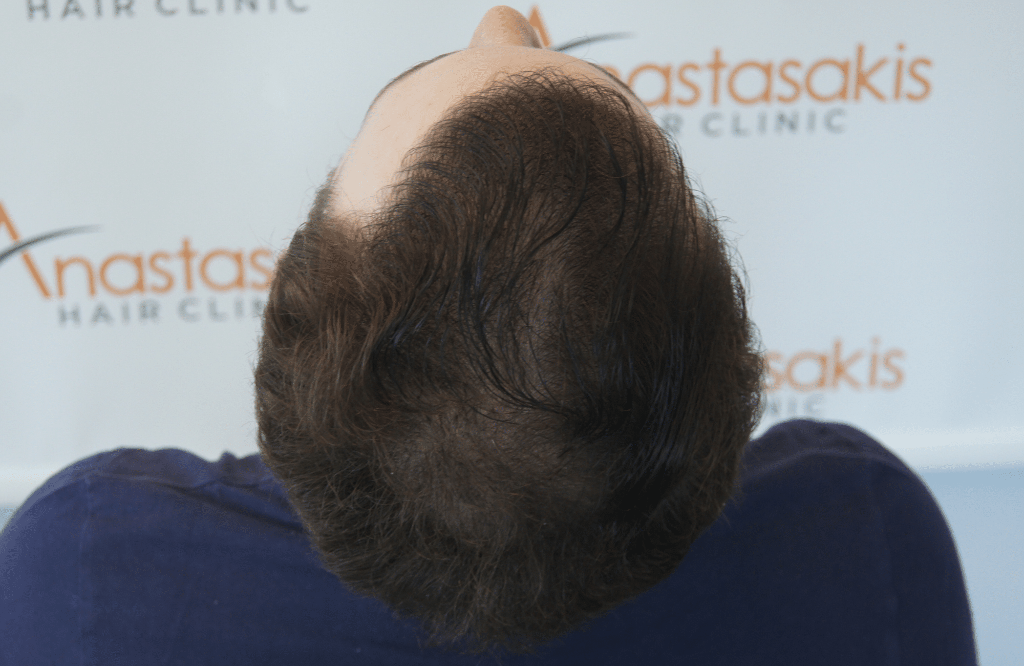 hair transplant result with 2500 follicular units anastasakis hair clinic
