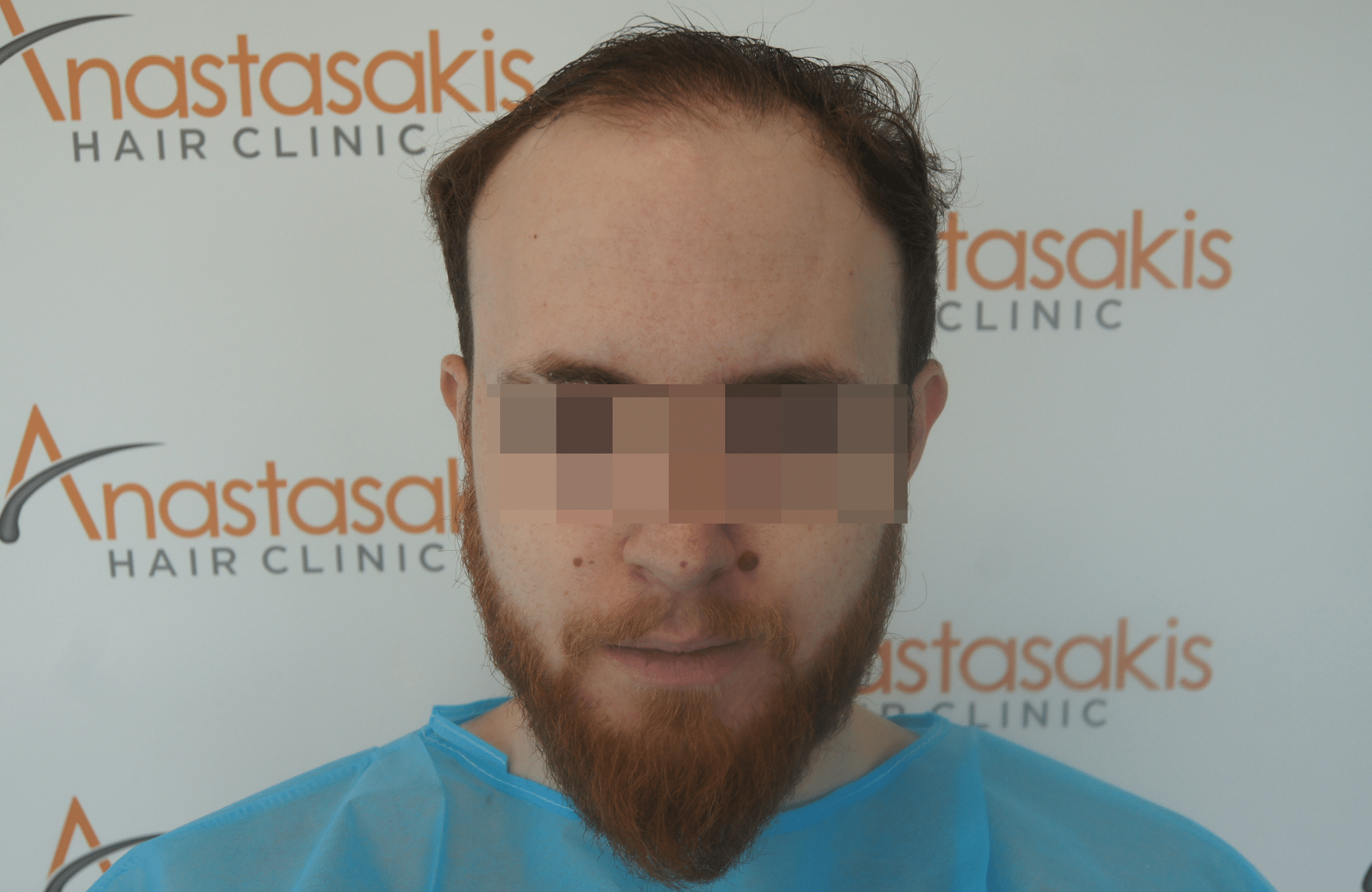 hair transplant result with 2500 follicular units anastasakis hair clinic