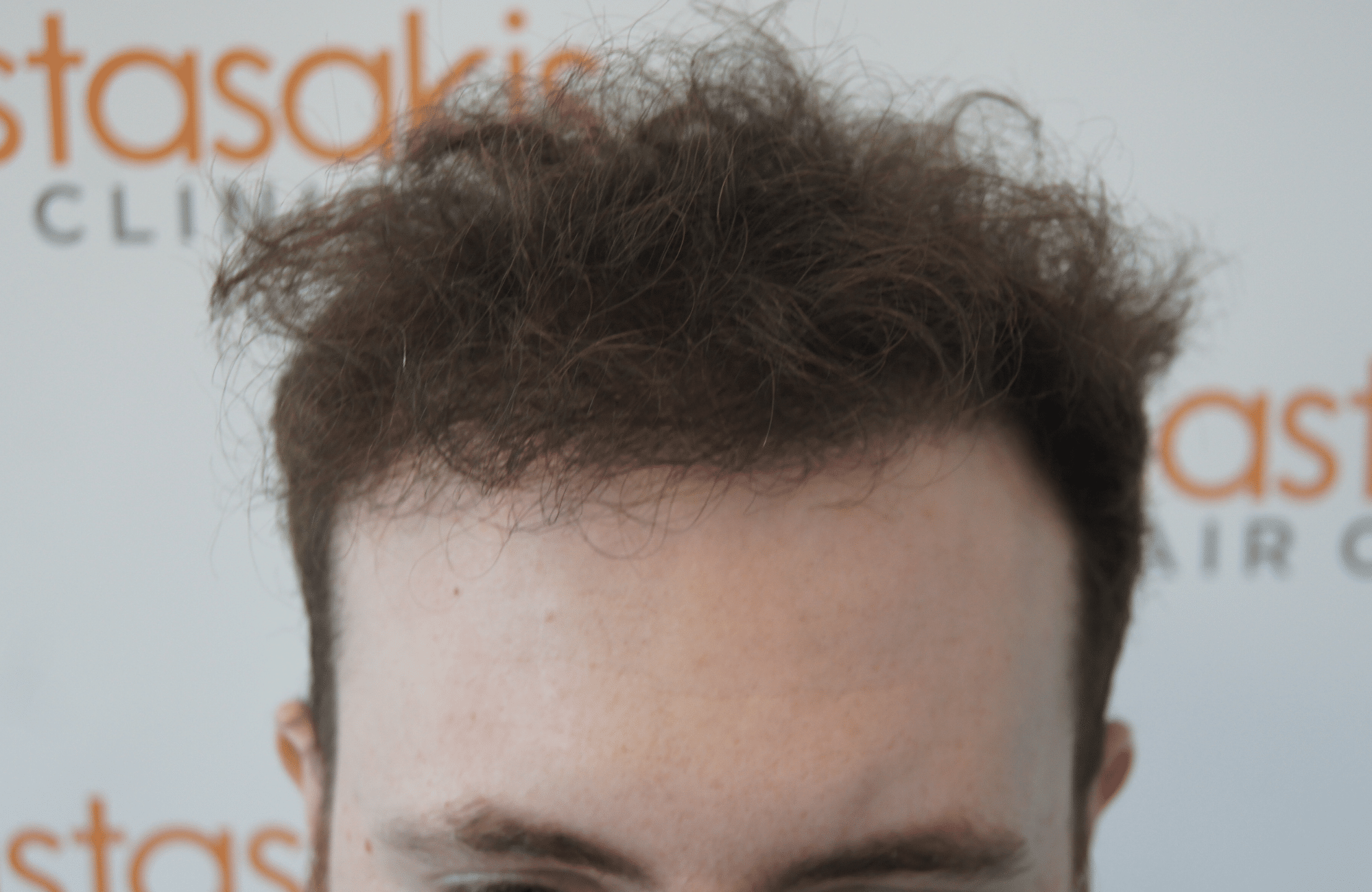 hair transplant result with 2500 follicular units anastasakis hair clinic