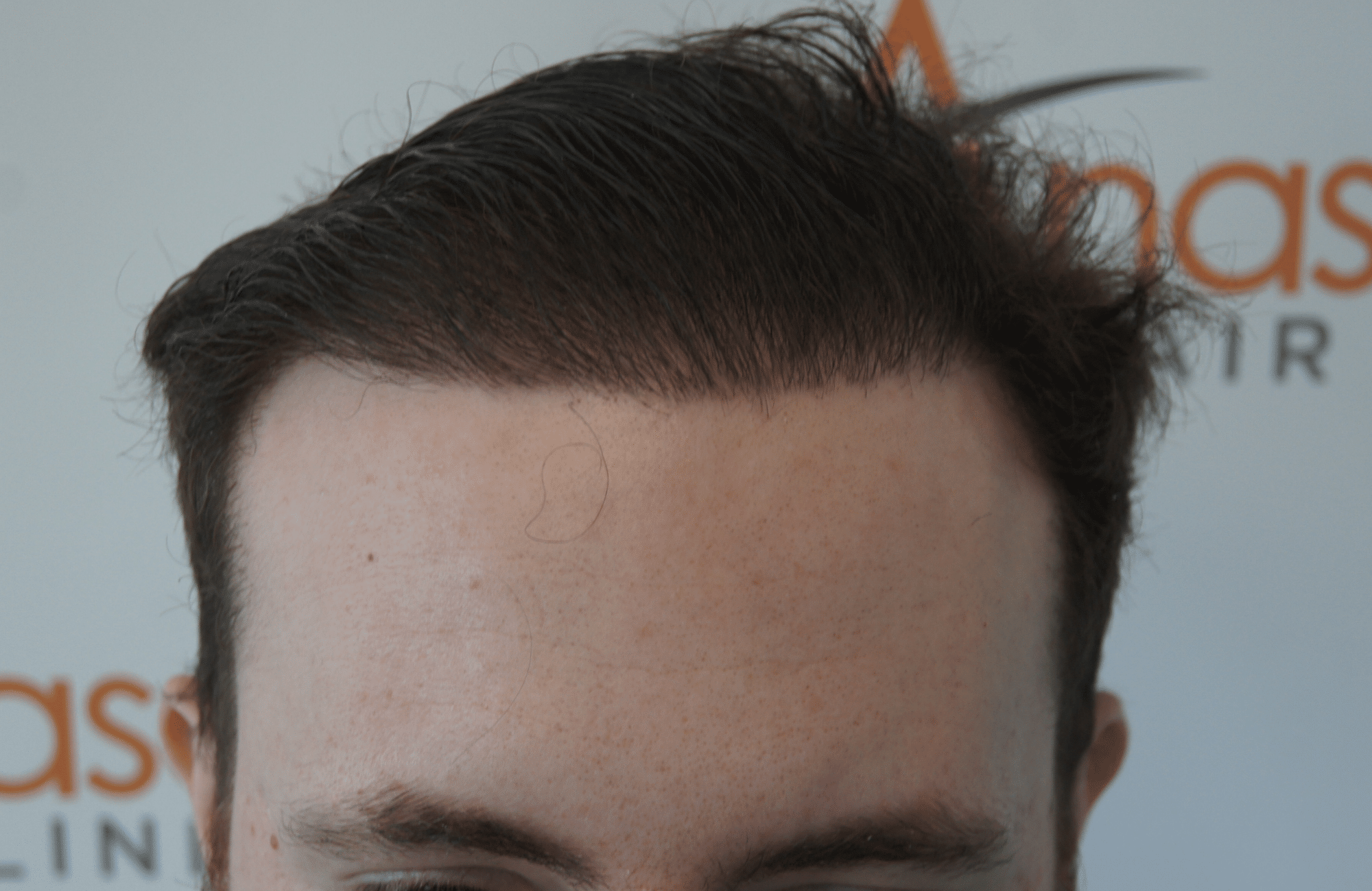 hair transplant result with 2500 follicular units anastasakis hair clinic