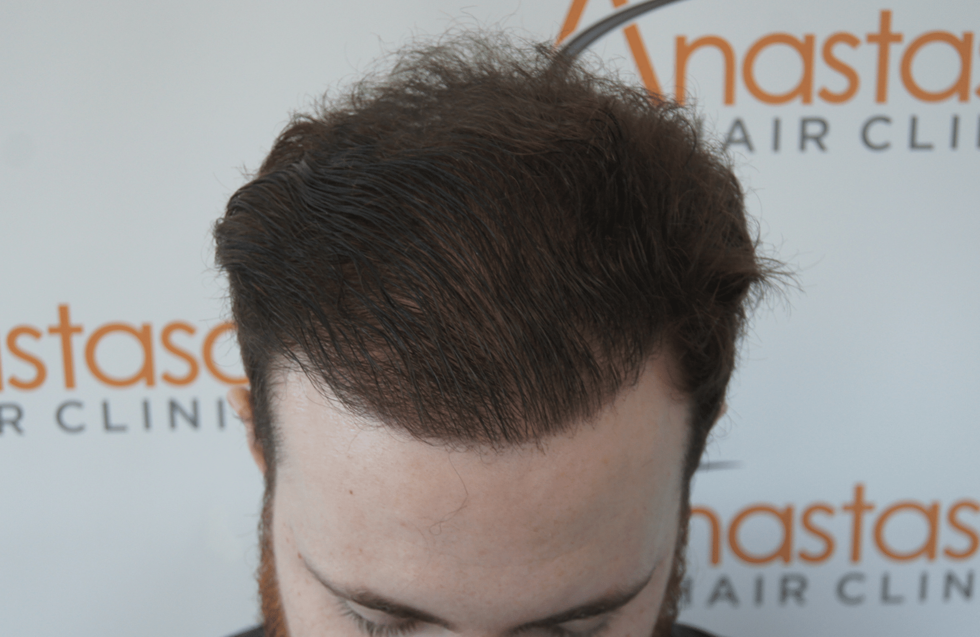 hair transplant result with 2500 follicular units anastasakis hair clinic