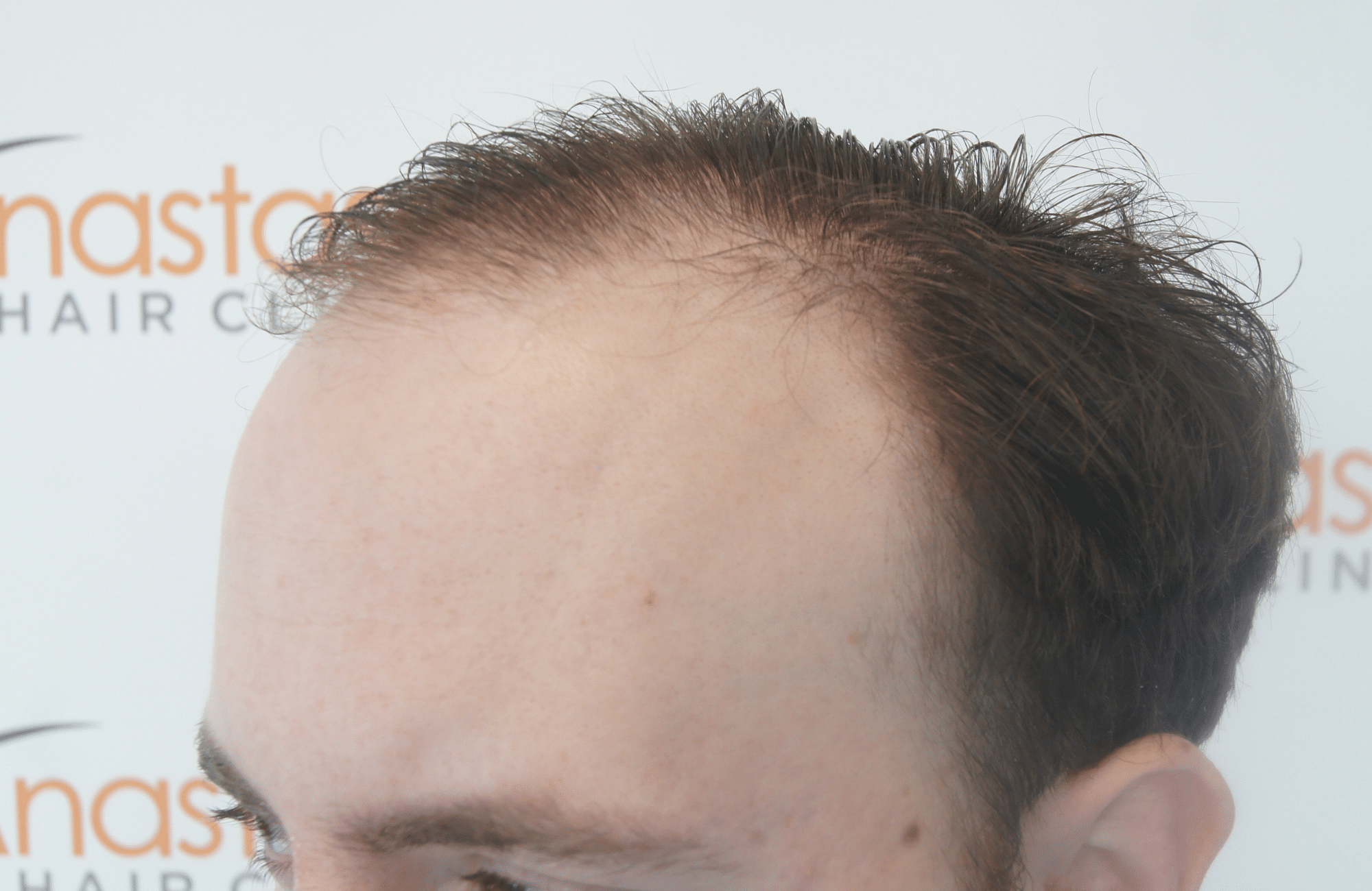hair transplant result with 2500 follicular units anastasakis hair clinic