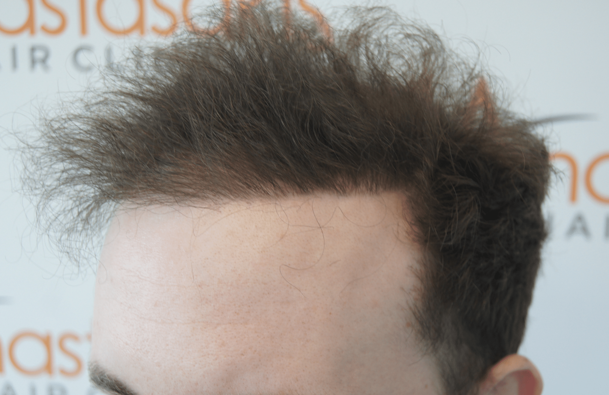 hair transplant result with 2500 follicular units anastasakis hair clinic