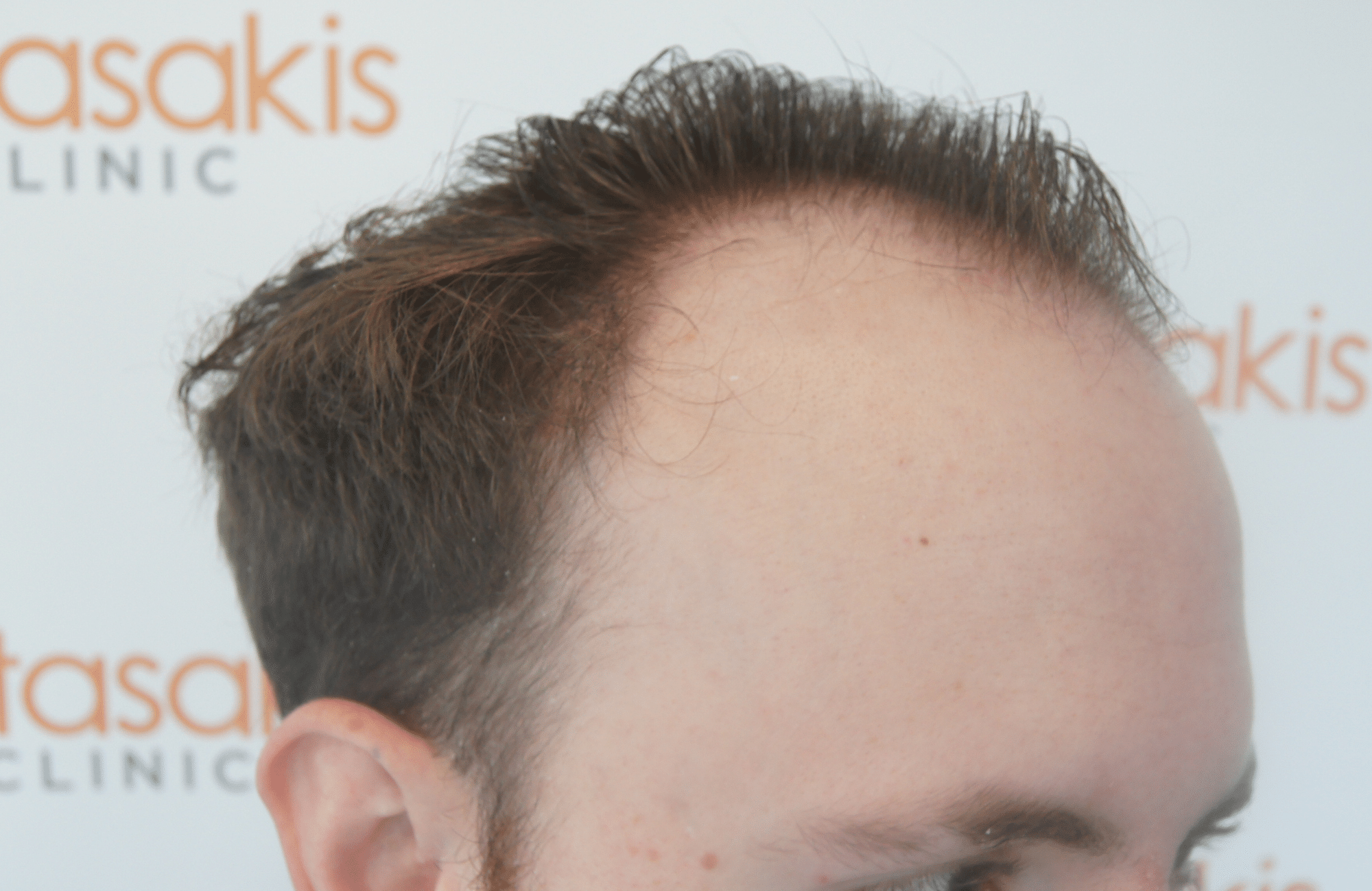 hair transplant result with 2500 follicular units anastasakis hair clinic