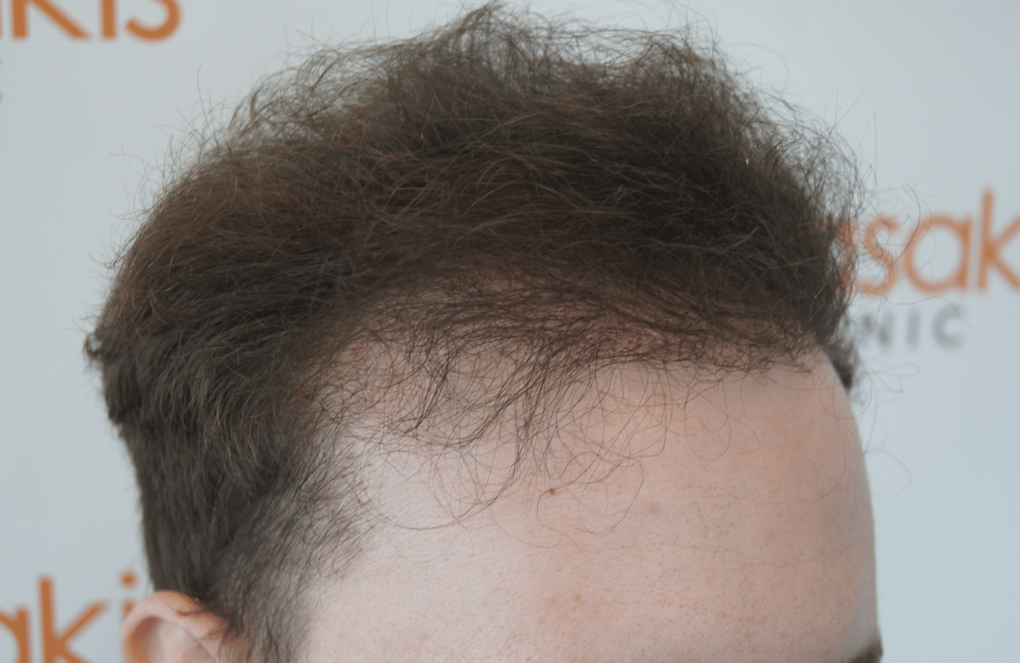 hair transplant result with 2500 follicular units anastasakis hair clinic