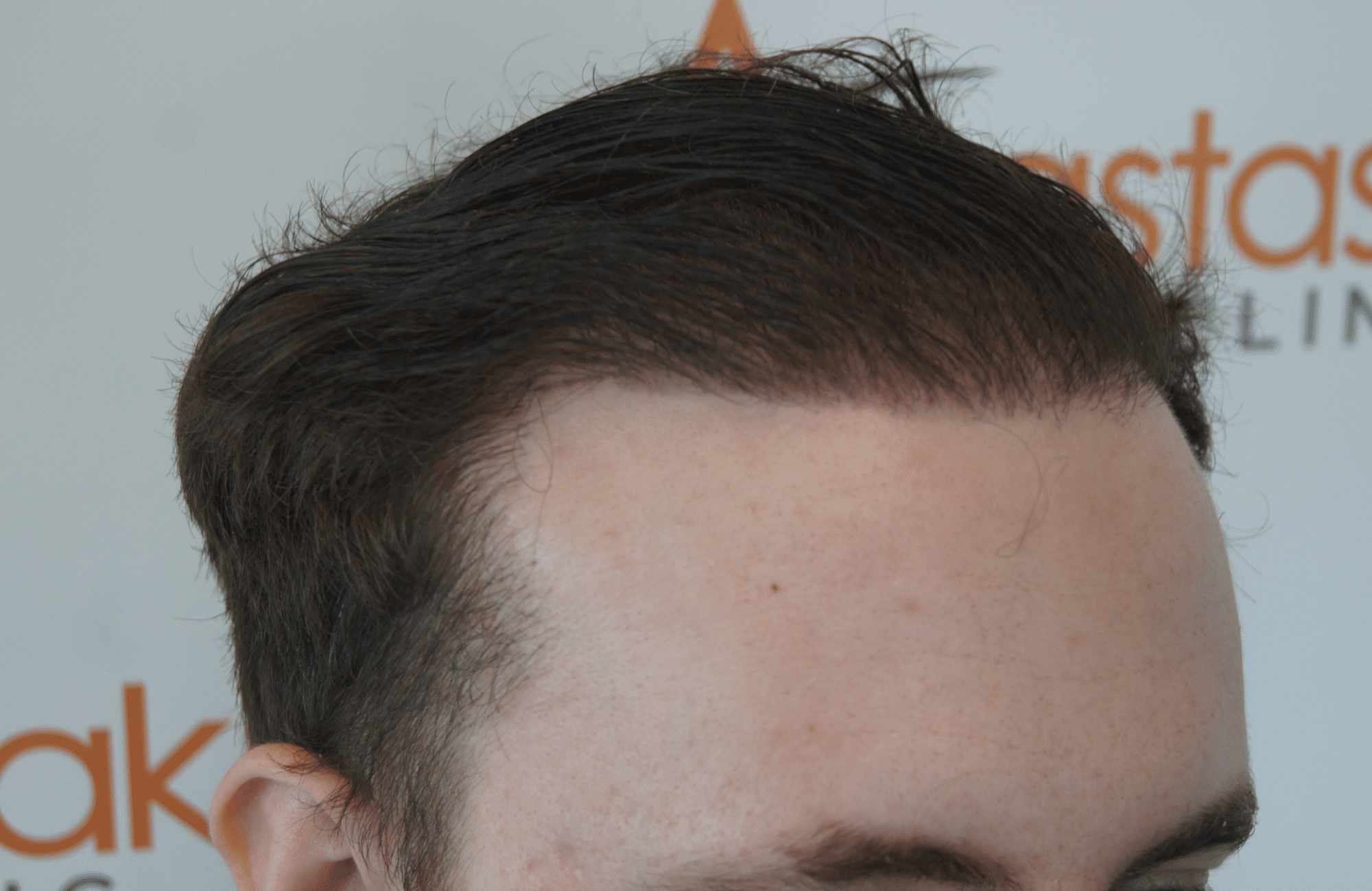 hair transplant result with 2500 follicular units anastasakis hair clinic