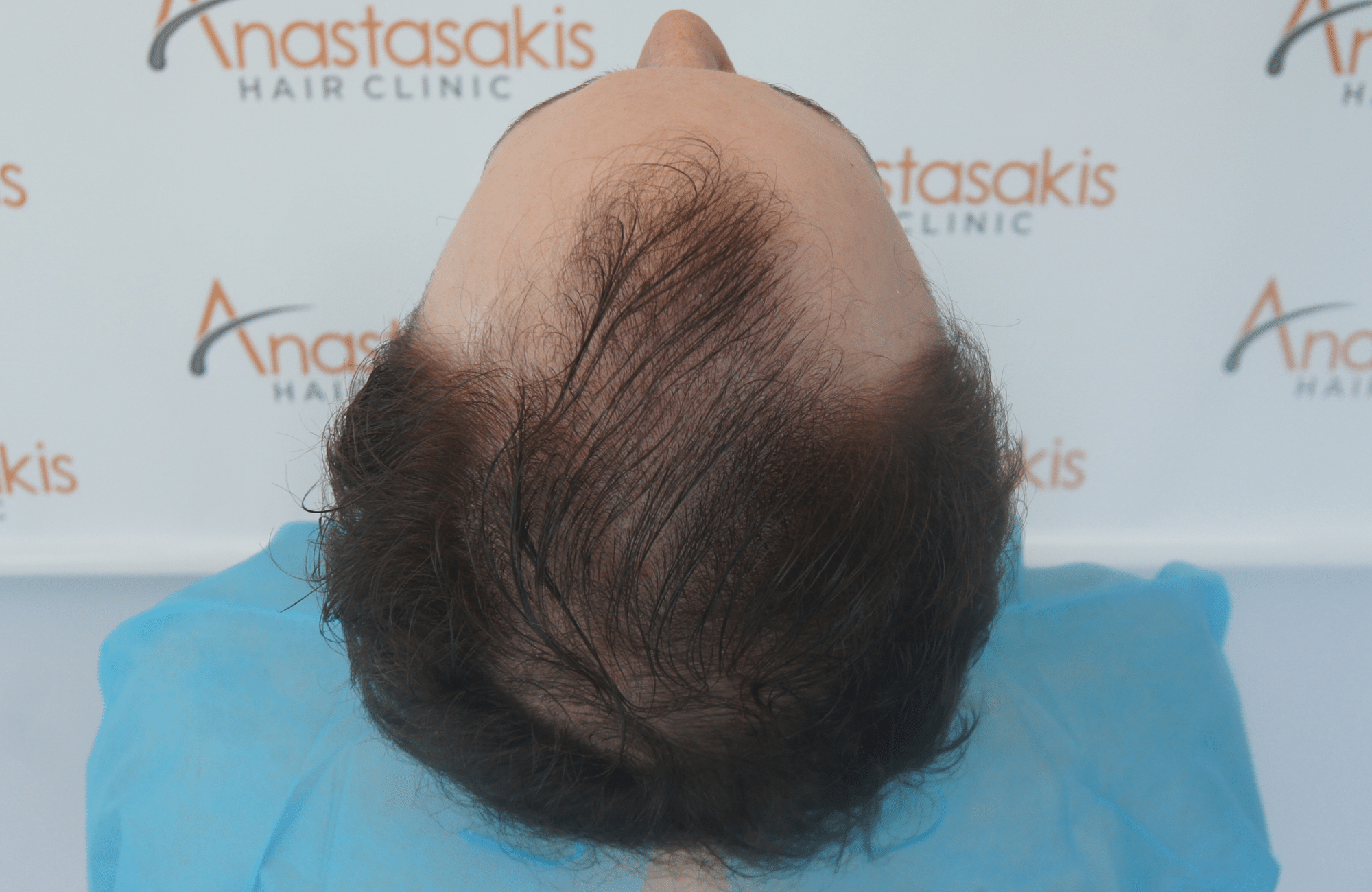 hair transplant result with 2500 follicular units anastasakis hair clinic