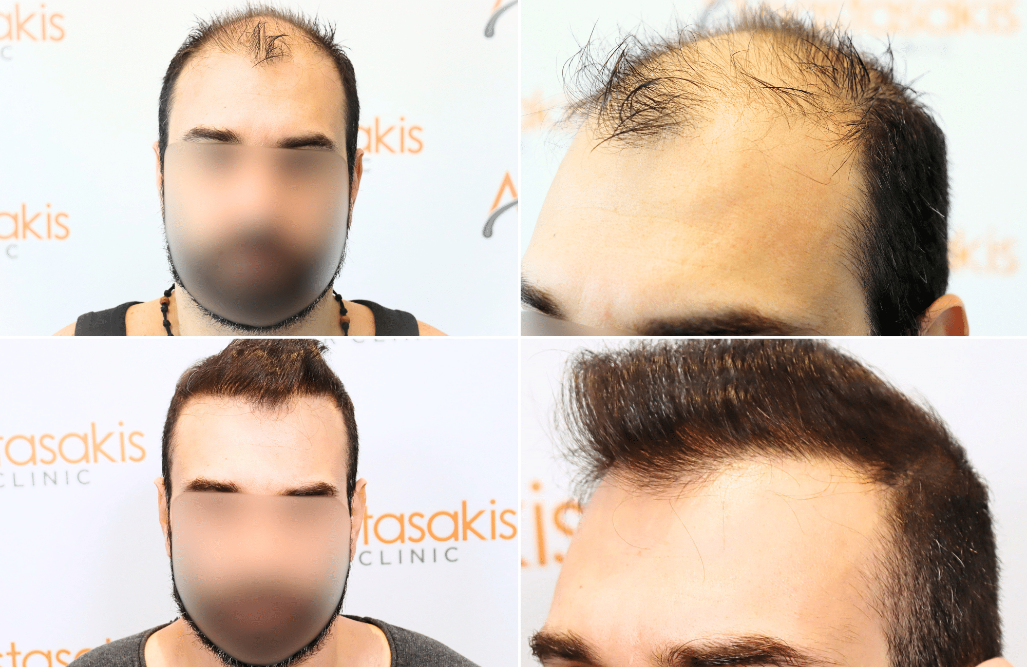 https://www.anastasakishairclinic.gr/portfolio/apotelesma-metamosxefsis-mallion-anastasakis-hair-clinic-70/