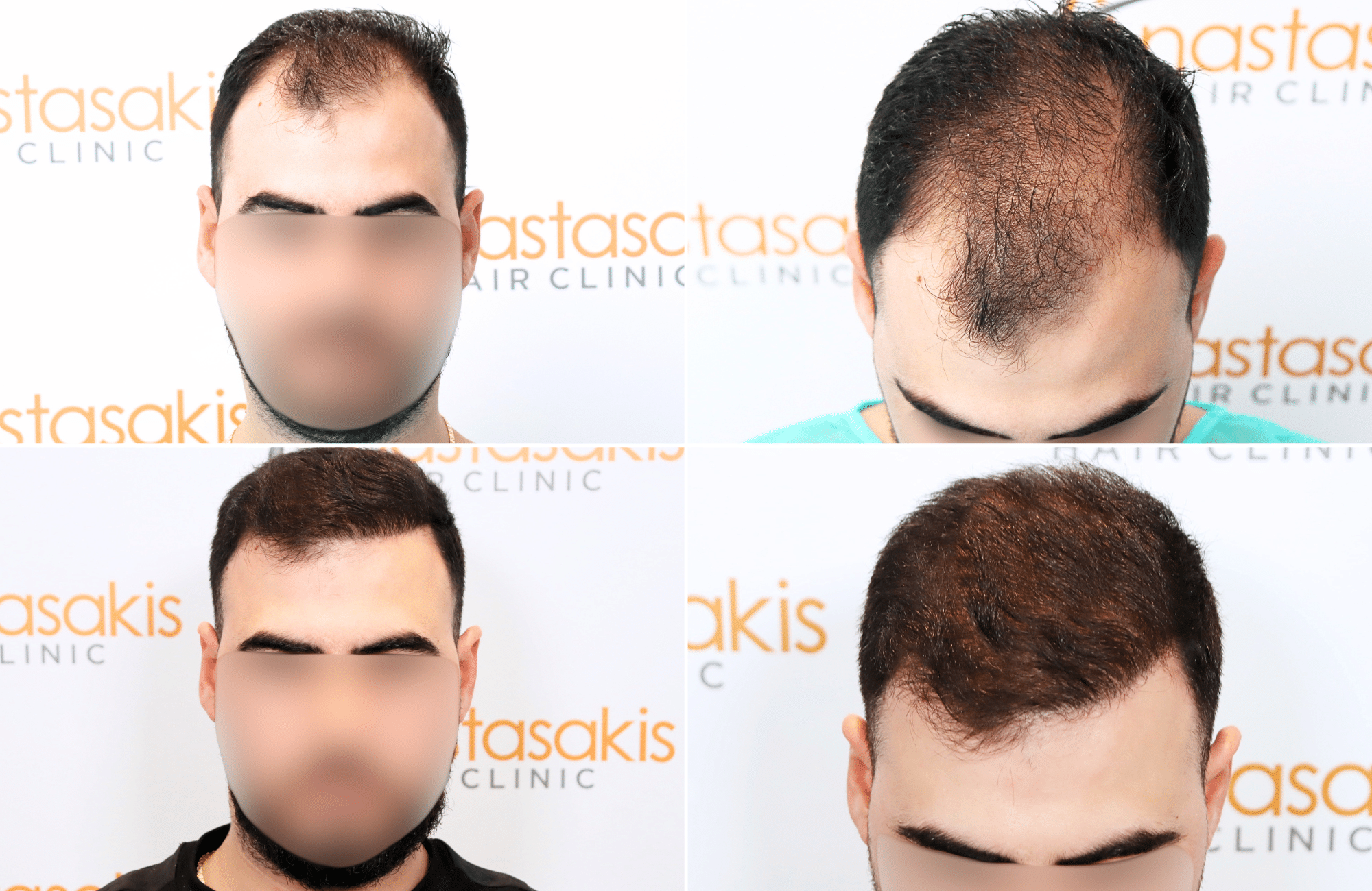https://www.anastasakishairclinic.gr/portfolio/apotelesma-metamosxefsis-mallion-anastasakis-hair-clinic-232/