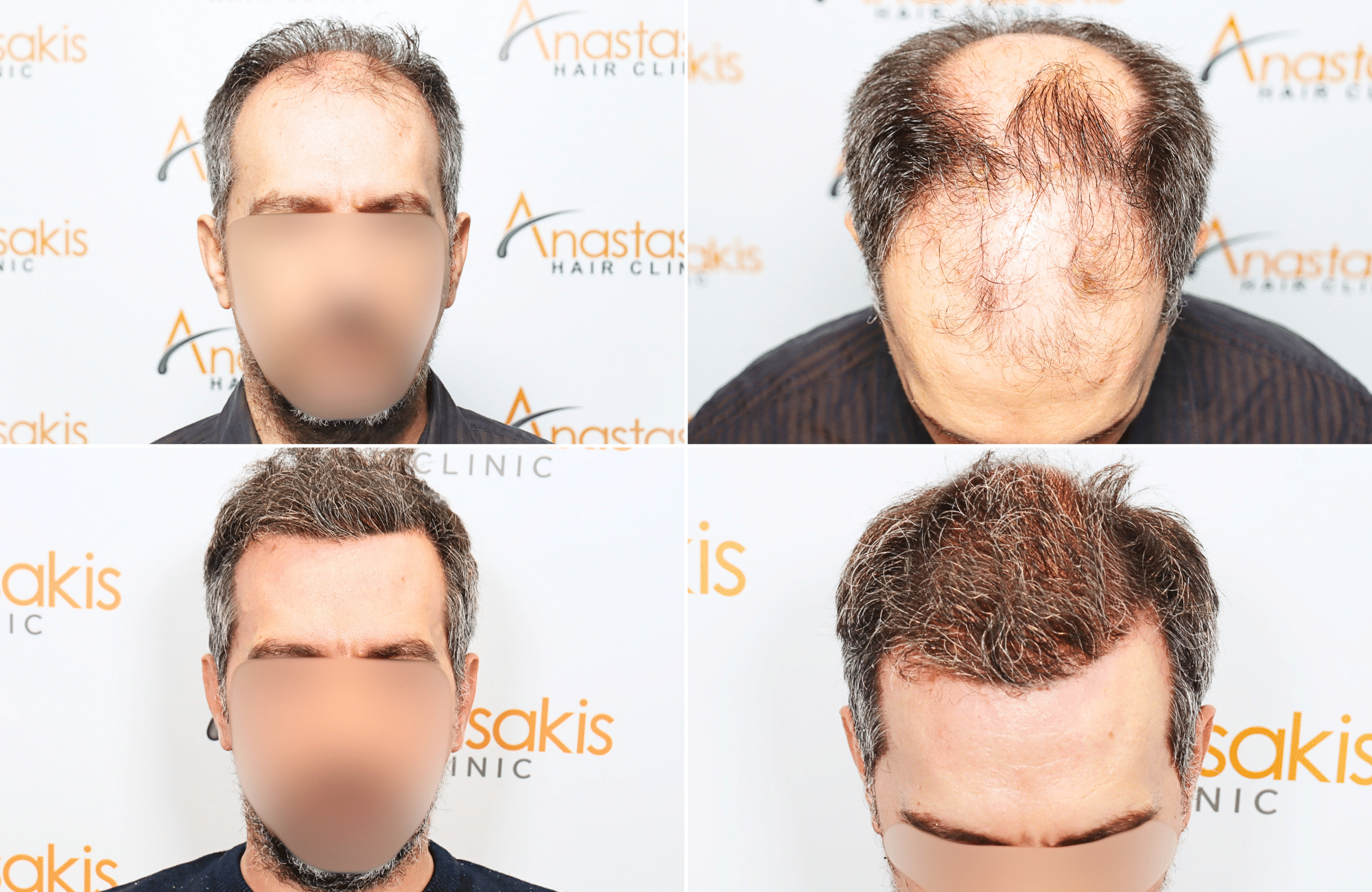 https://www.anastasakishairclinic.gr/portfolio/apotelesma-metamosxefsis-mallion-anastasakis-hair-clinic-110/