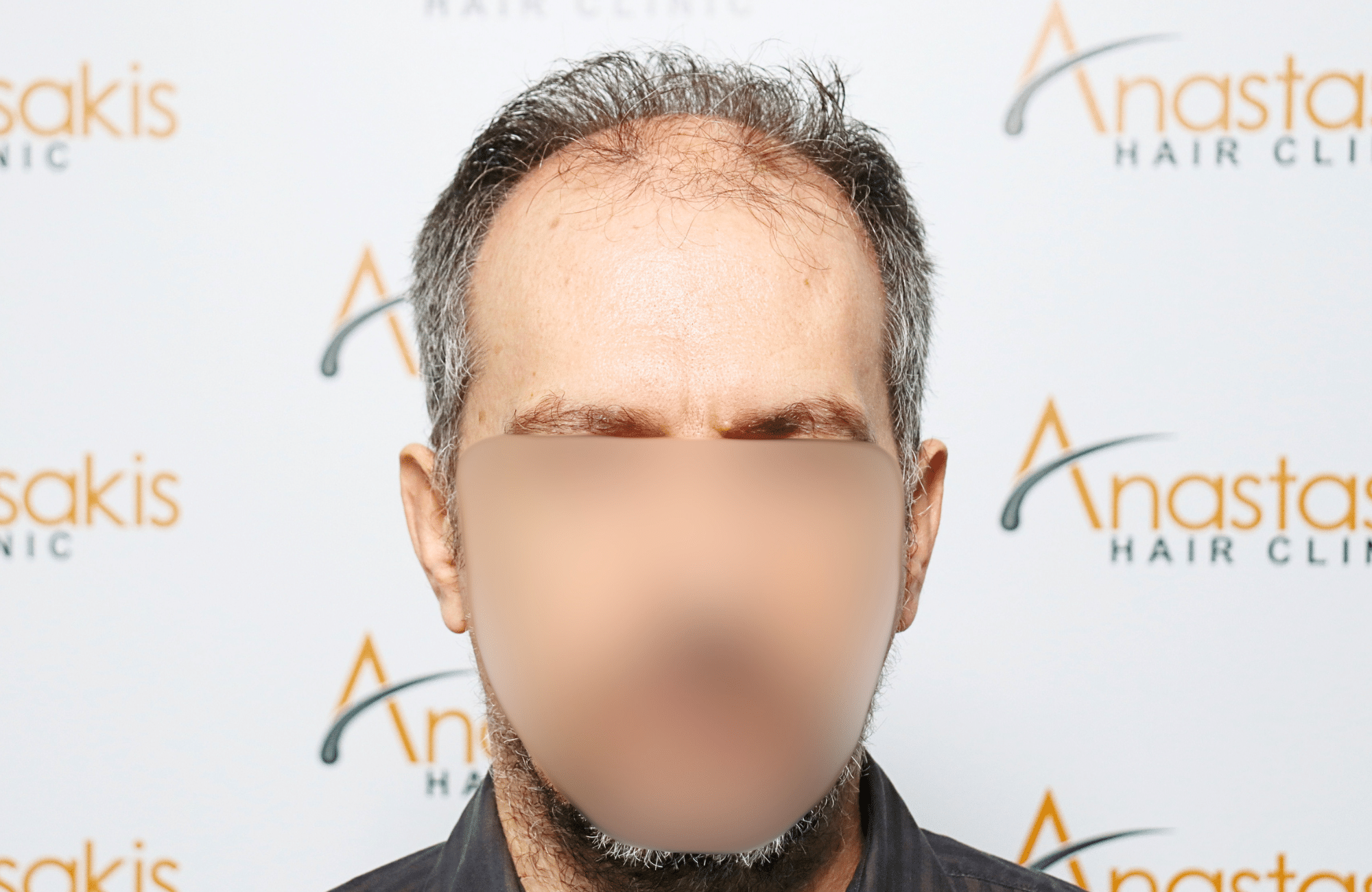 hair transplant result with 2600 fus anastasakis hair clinic fullface before