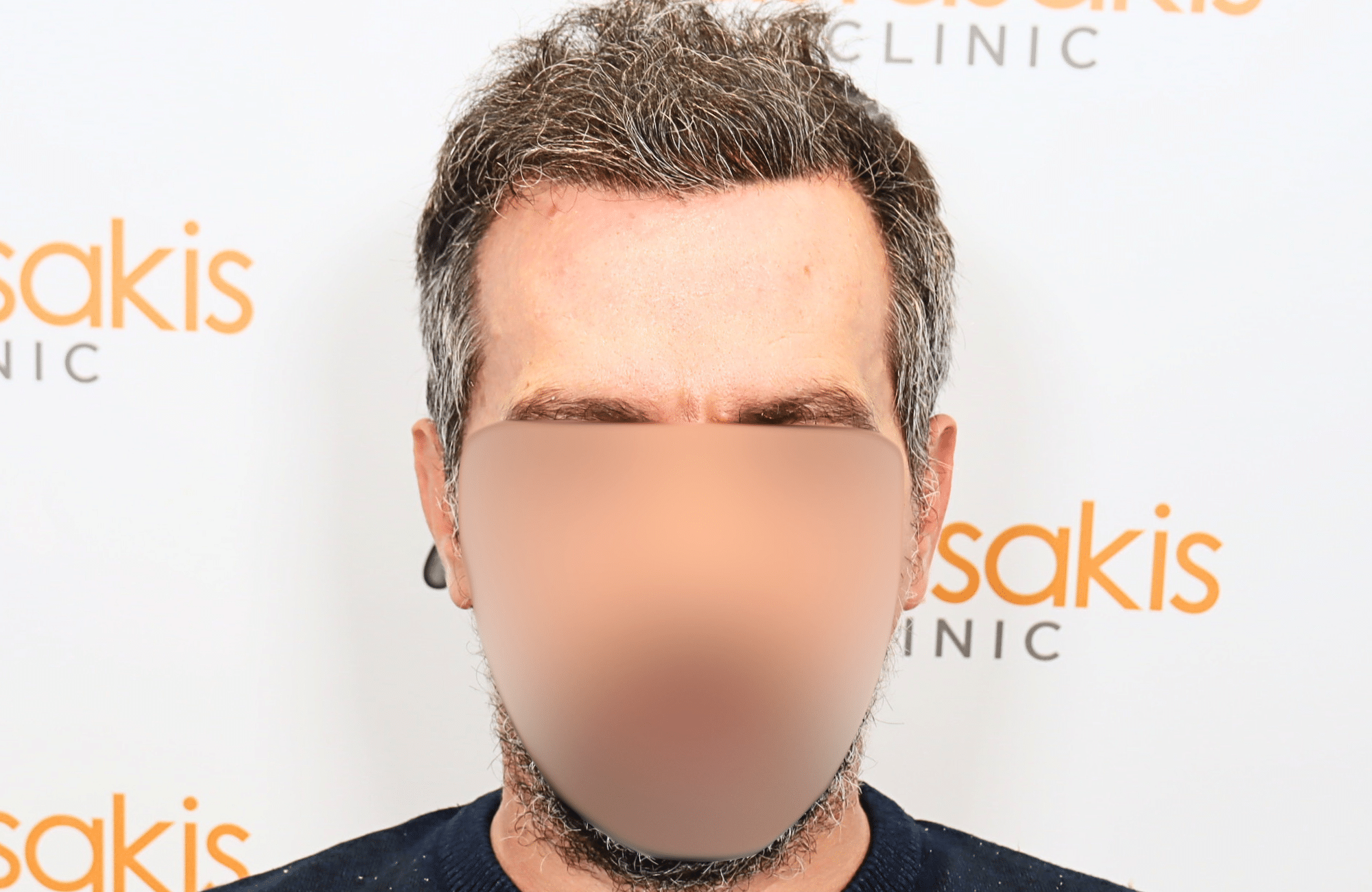 hair transplant result with 2600 fus anastasakis hair clinic fullface after