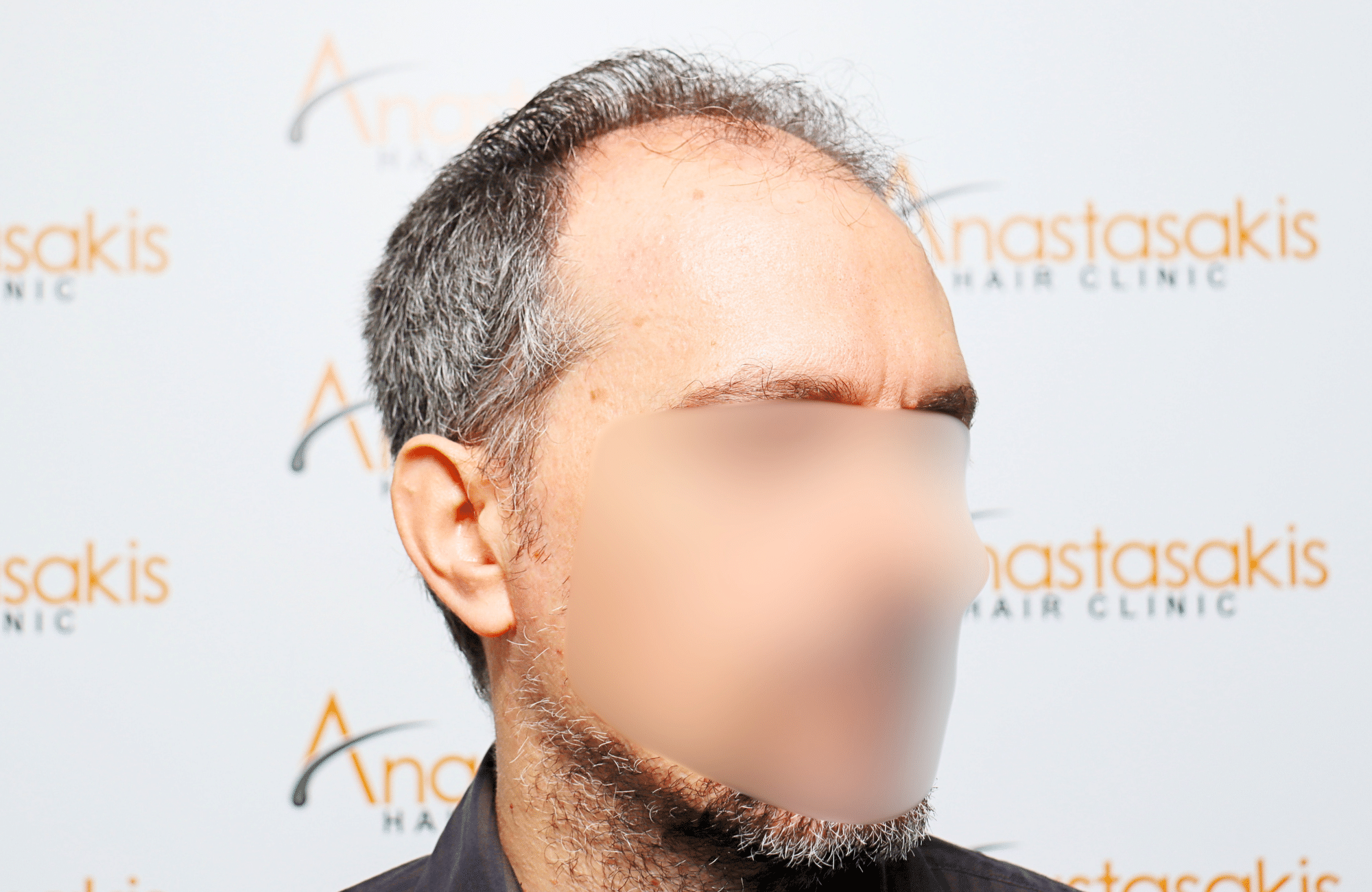 hair transplant result with 2600 fus anastasakis hair clinic side2 before