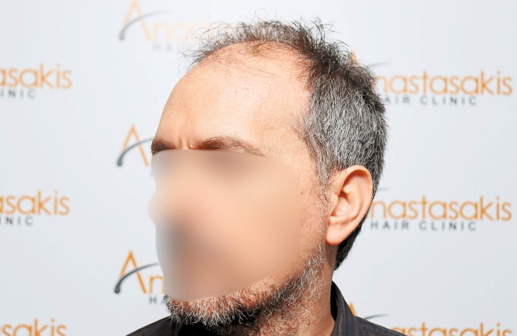 hair transplant result with 2600 fus anastasakis hair clinic side1 before