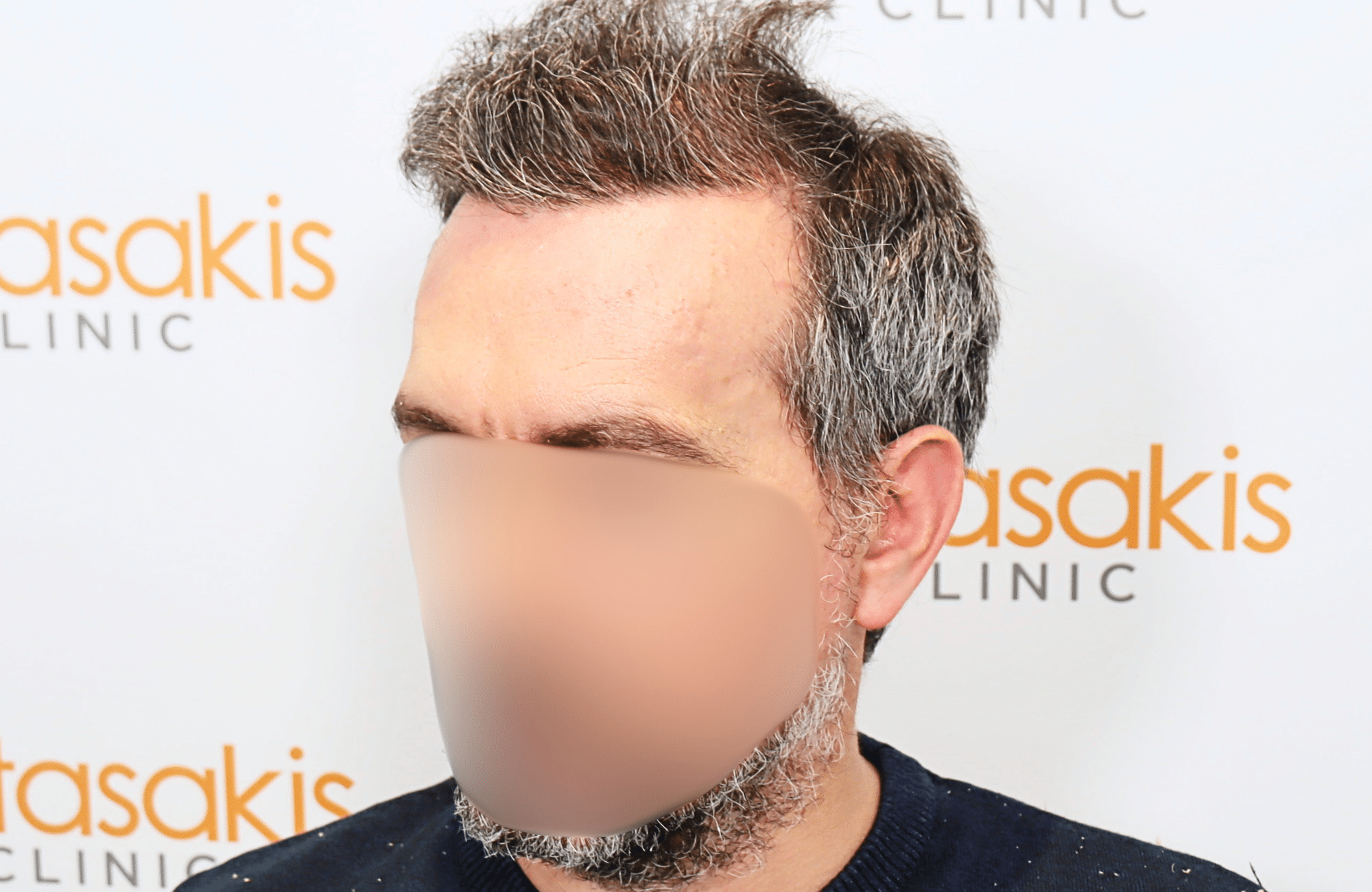 hair transplant result with 2600 fus anastasakis hair clinic side1 after