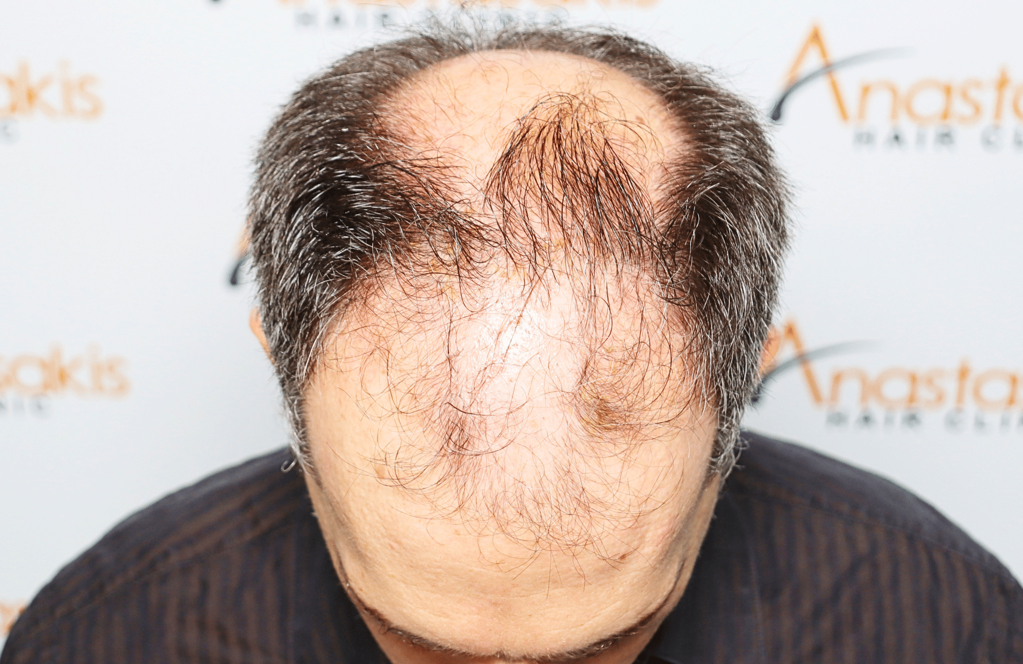 hair transplant result with 2600 fus anastasakis hair clinic frontal before