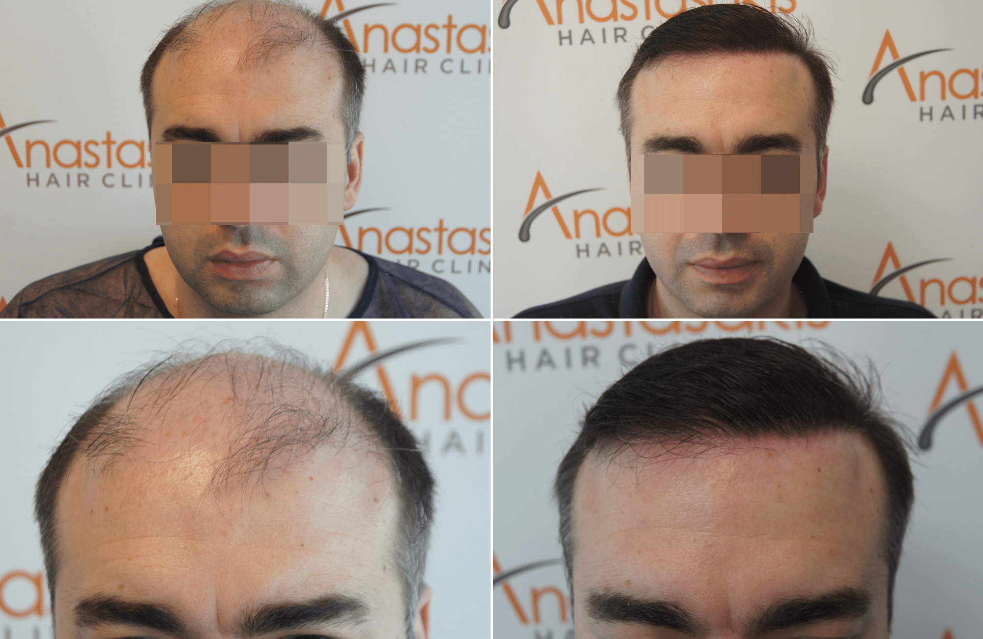 hair transplant result with 3200 follicular units anastasakis hair clinic