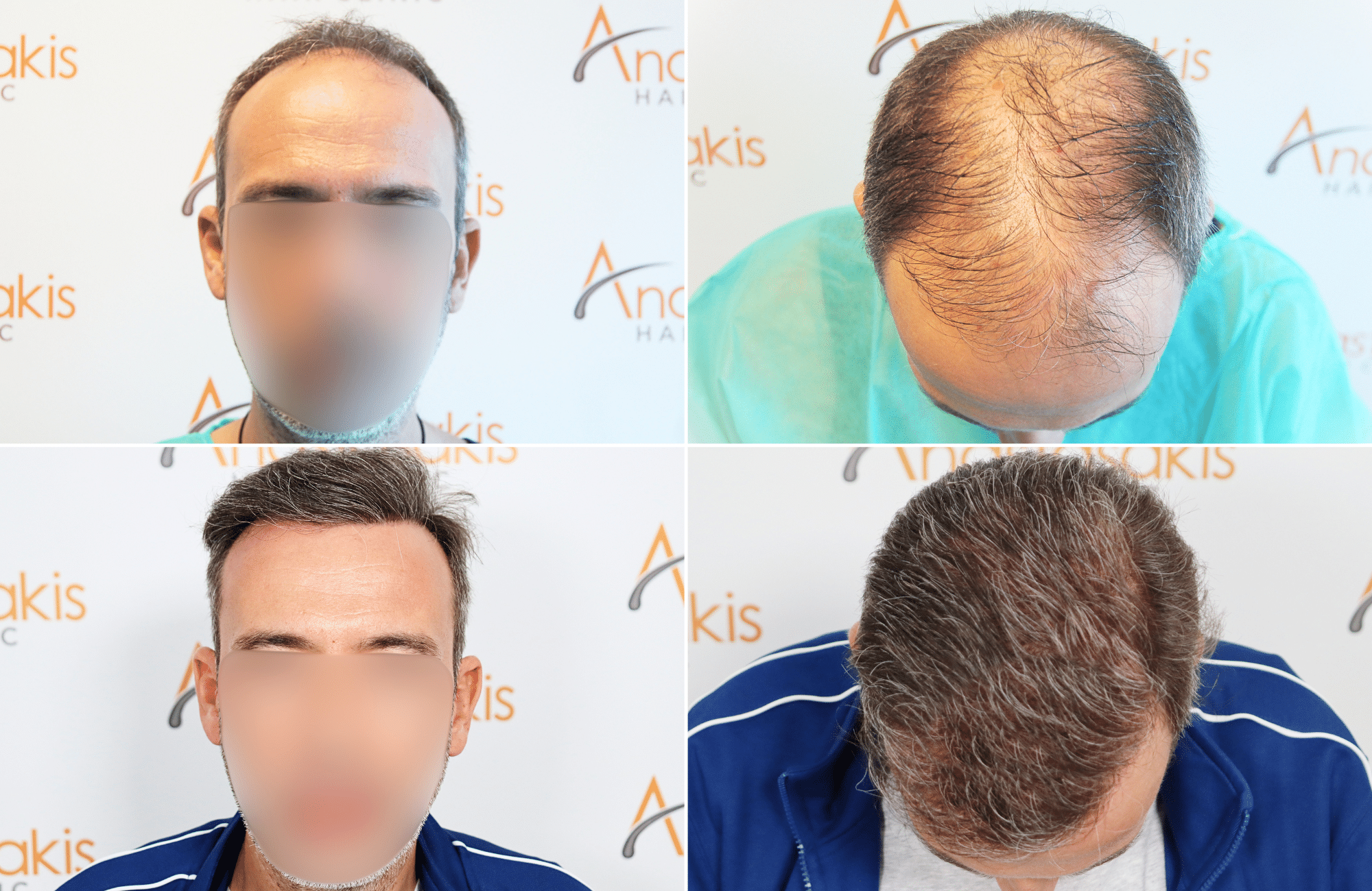 https://www.anastasakishairclinic.gr/portfolio/apotelesma-metamosxefsis-mallion-anastasakis-hair-clinic-23/