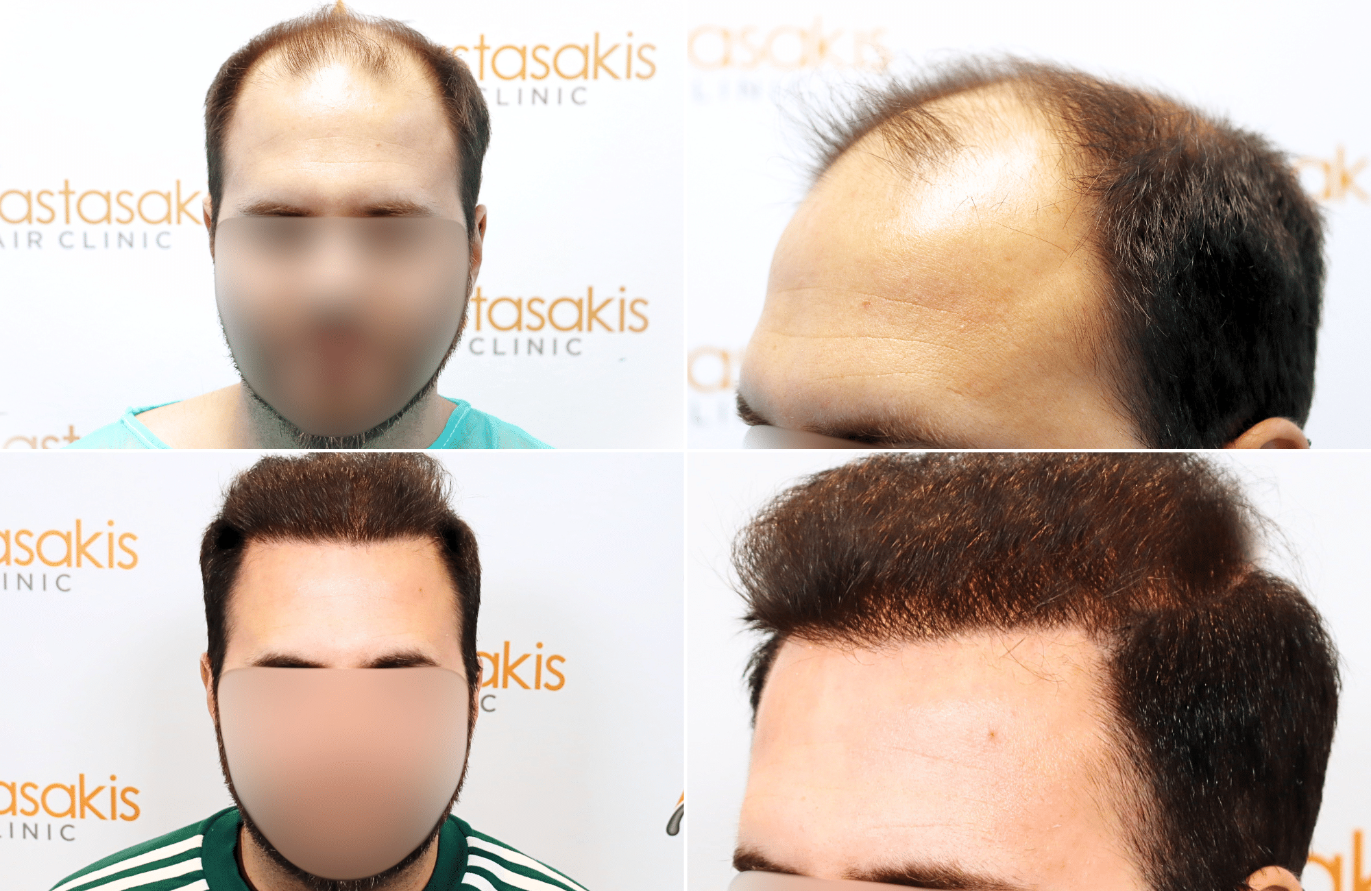 https://www.anastasakishairclinic.gr/portfolio/apotelesma-metamosxefsis-mallion-anastasakis-hair-clinic-78/