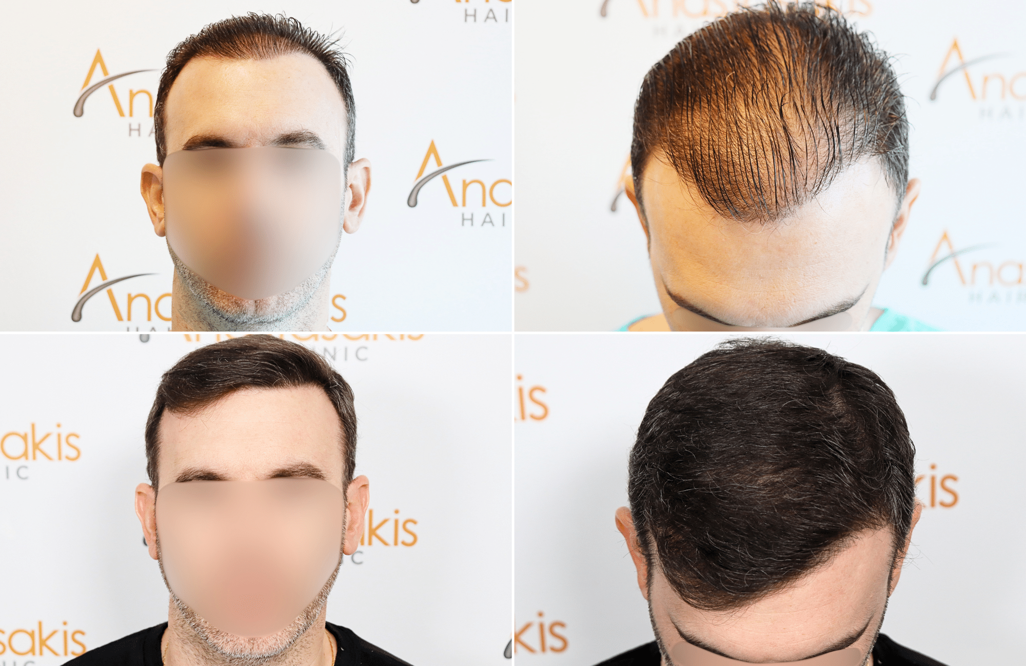 https://www.anastasakishairclinic.gr/portfolio/apotelesma-metamosxefsis-mallion-anastasakis-hair-clinic-189/