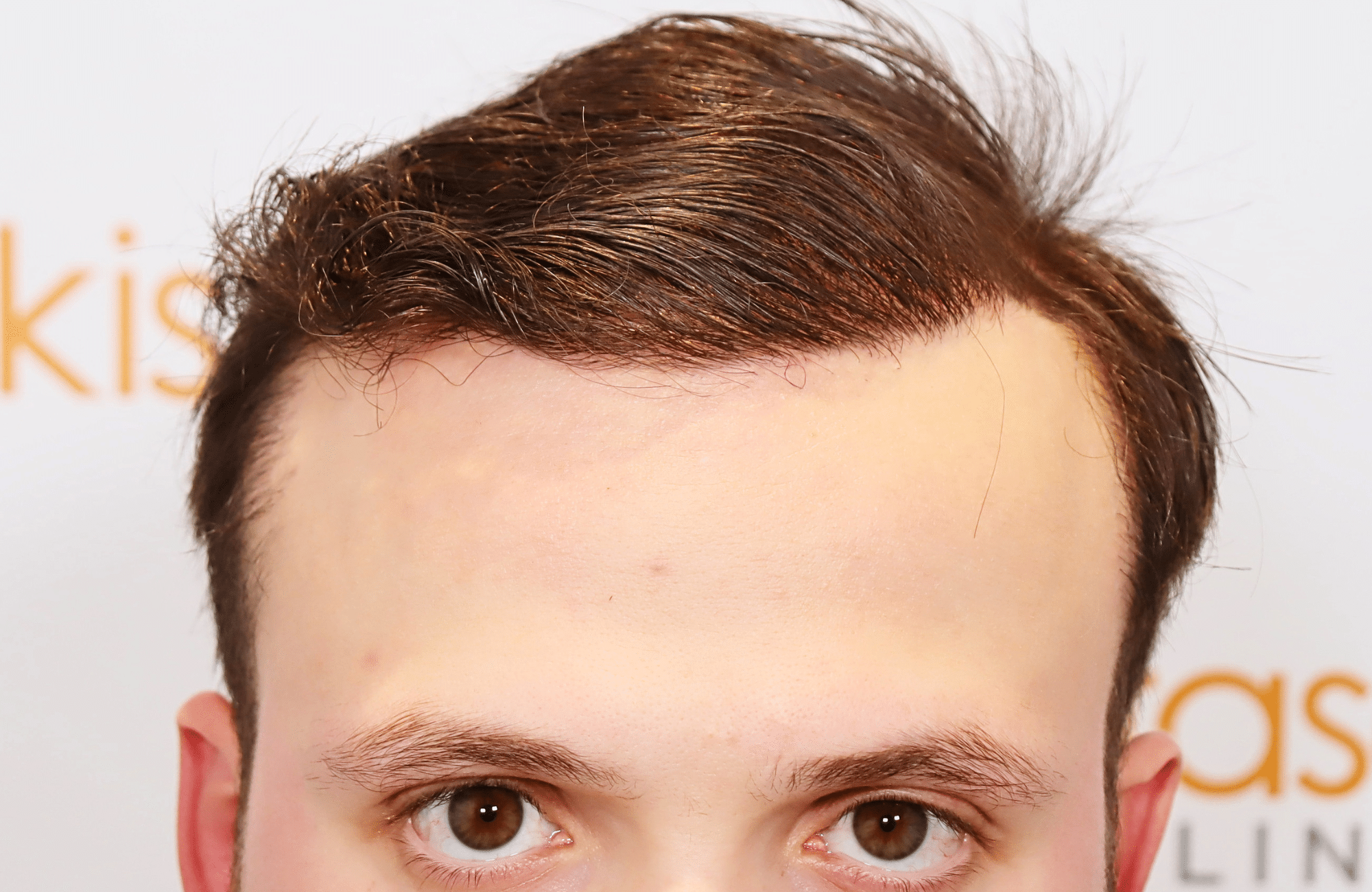 hair trensplant result 3500 fus 30 yr frontal