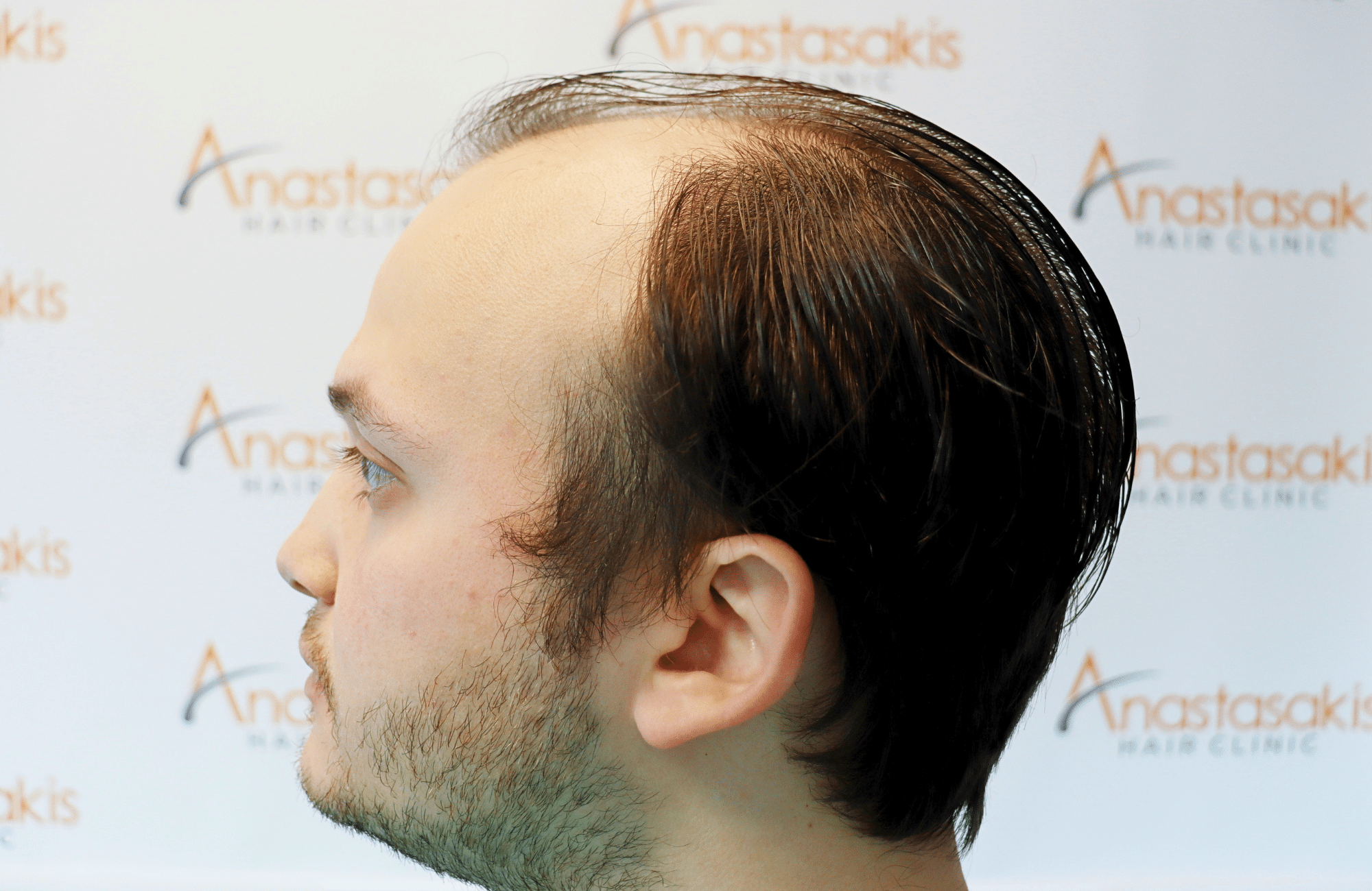 hair trensplant result 3500 fus 30 yr frontal