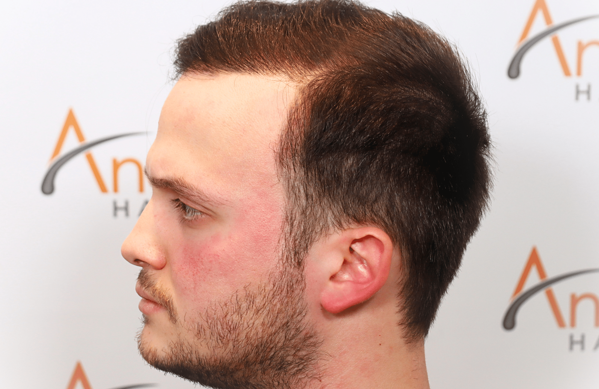hair trensplant result 3500 fus 30 yr frontal