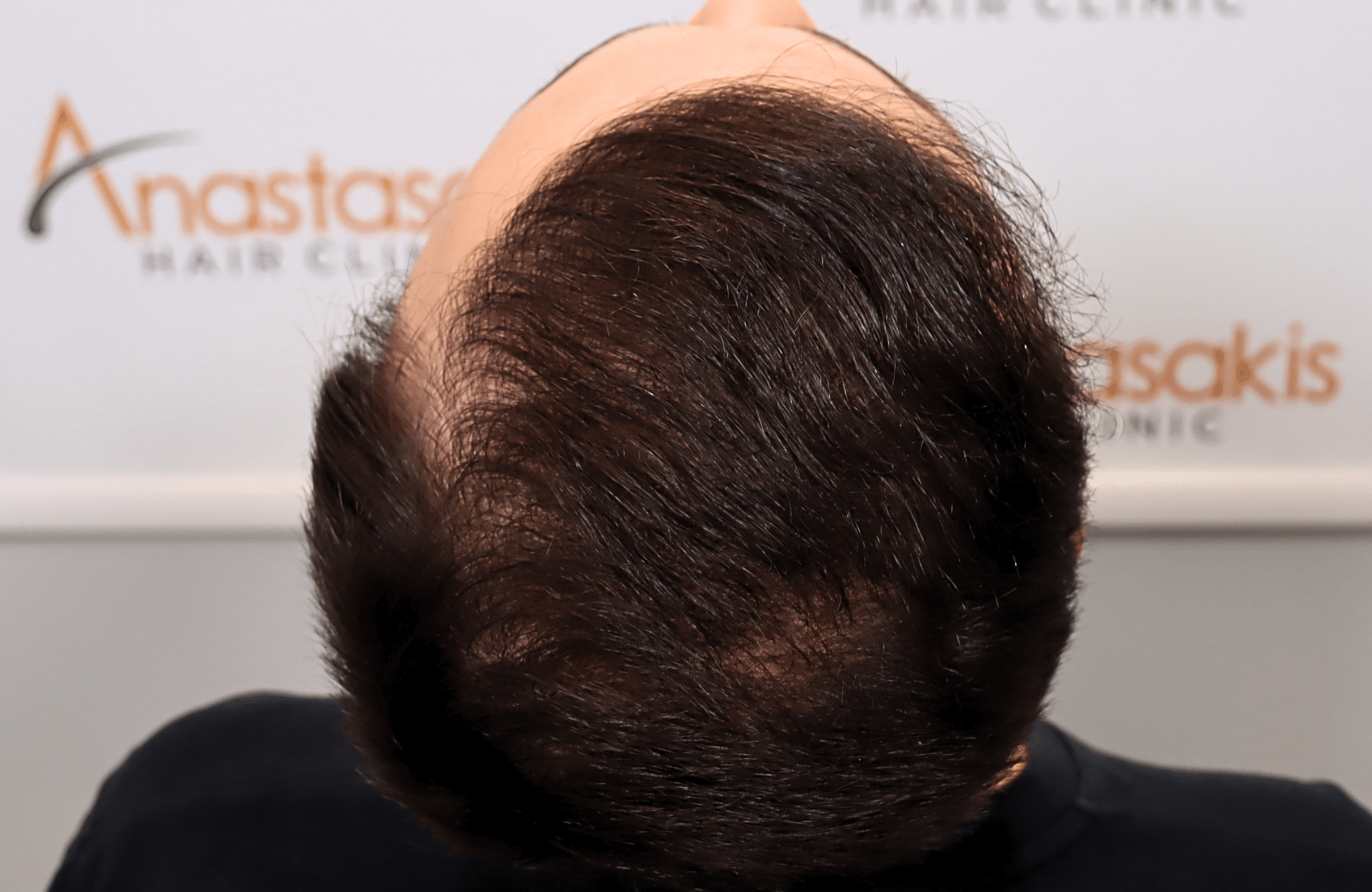 hair trensplant result 3500 fus 30 yr frontal