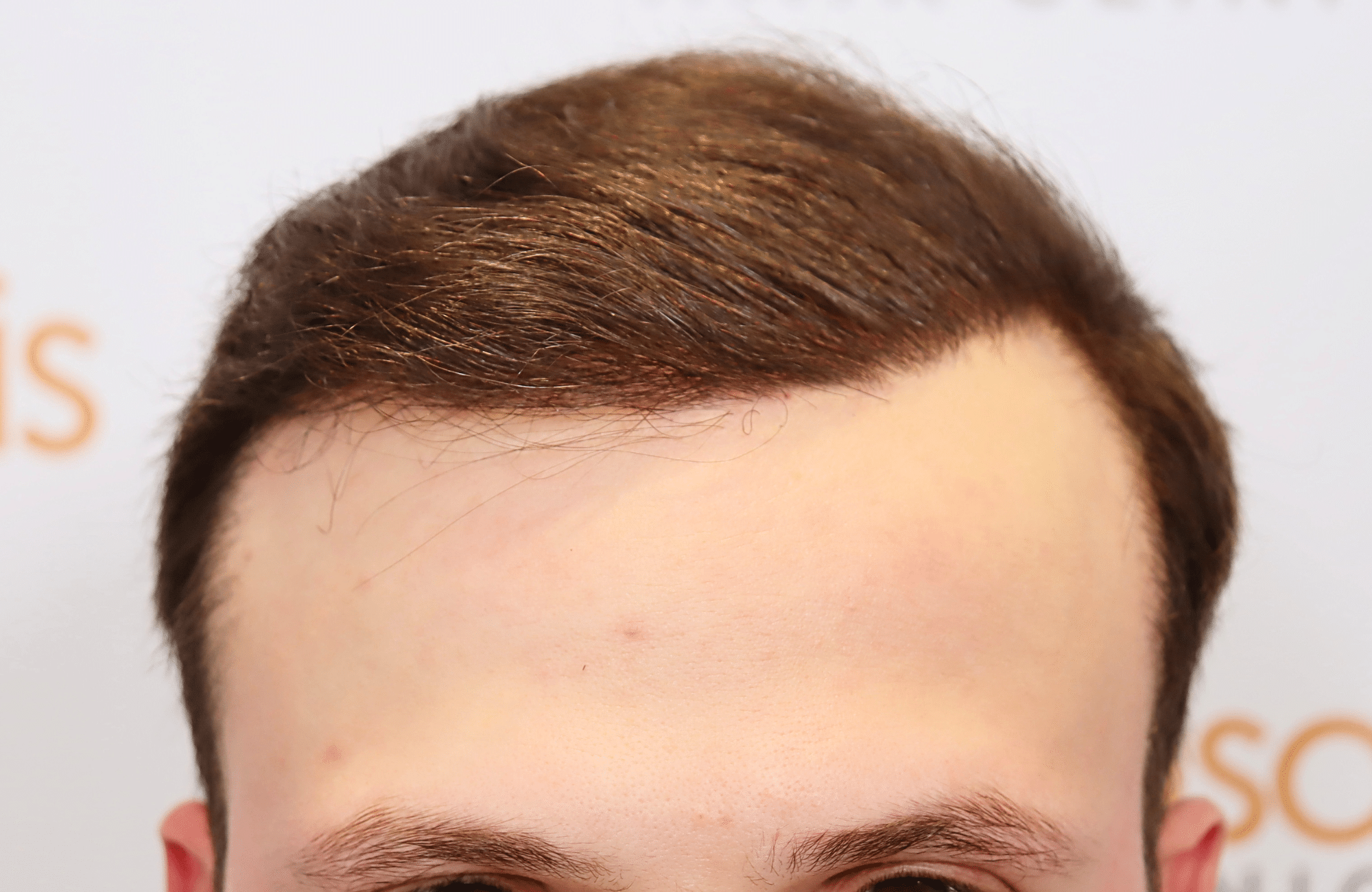 hair trensplant result 3500 fus 30 yr frontal