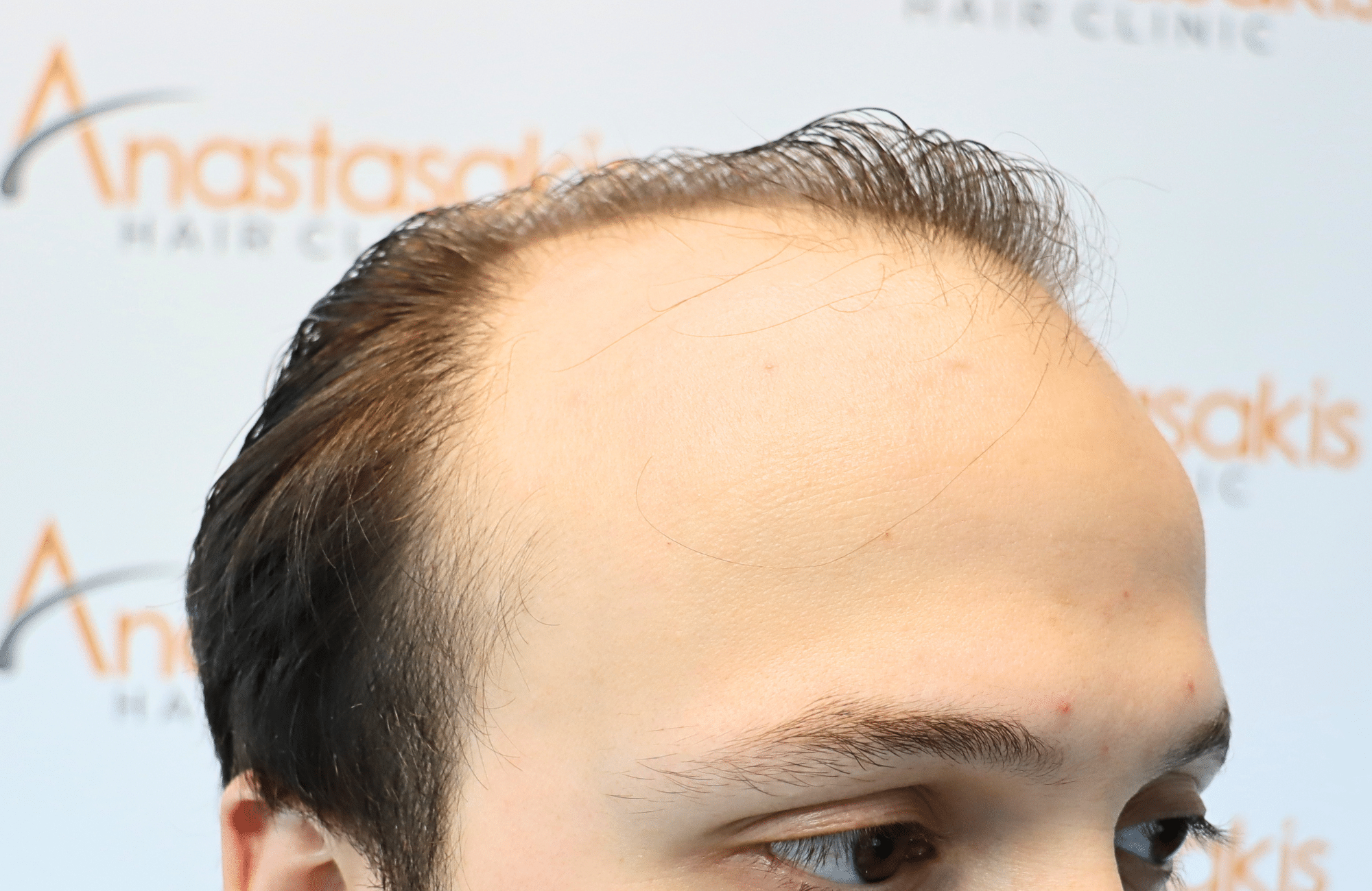 hair trensplant result 3500 fus 30 yr frontal