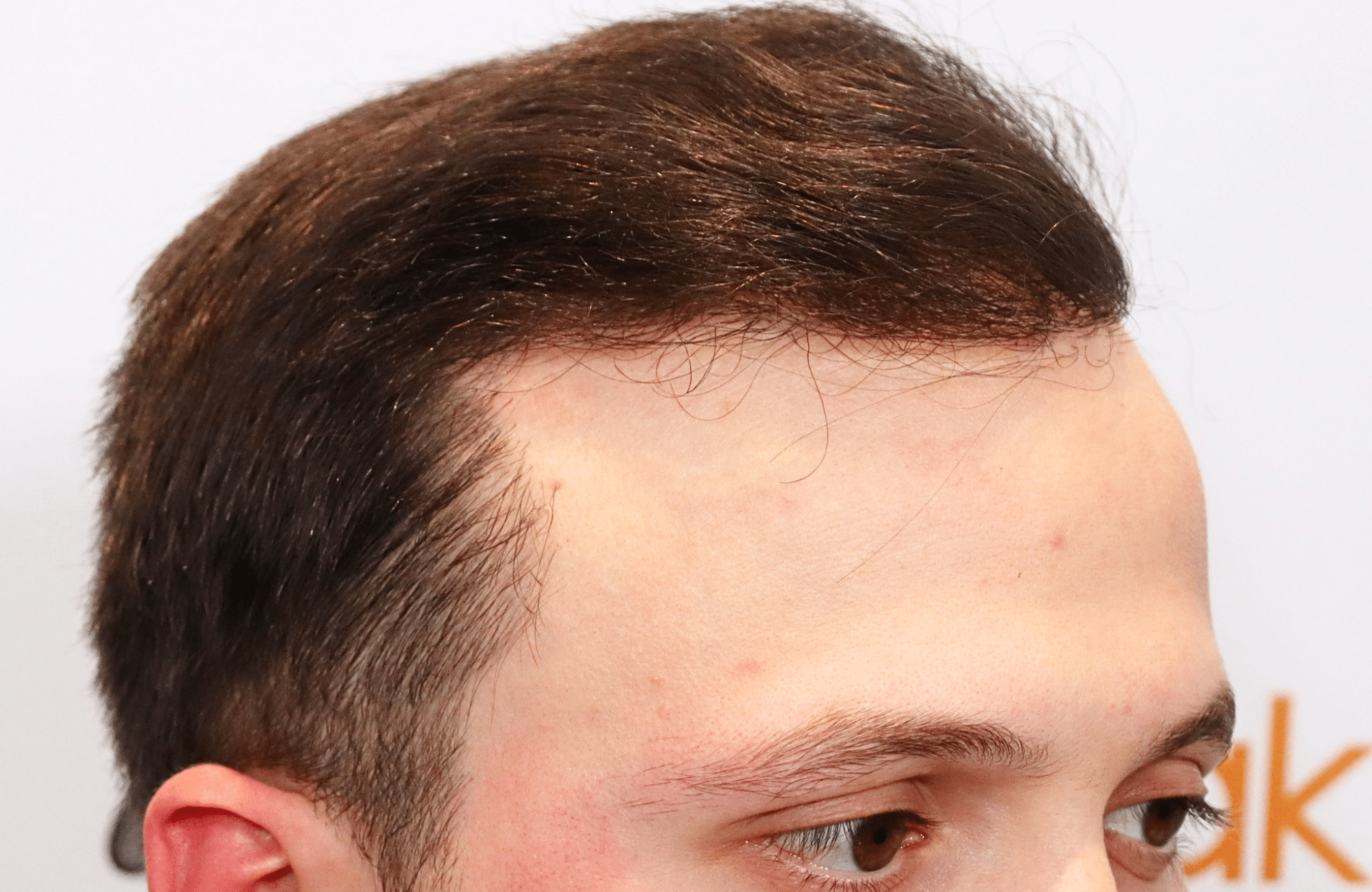 hair trensplant result 3500 fus 30 yr frontal