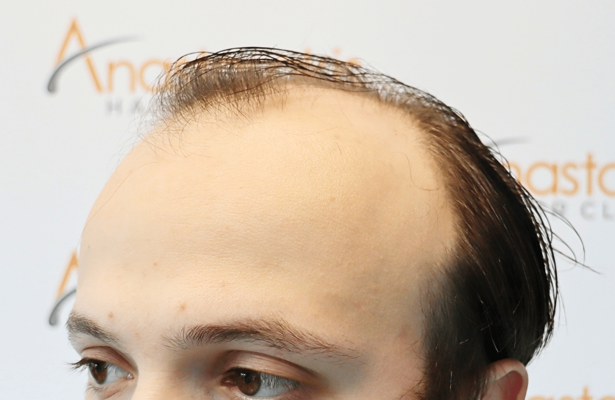 hair trensplant result 3500 fus 30 yr frontal