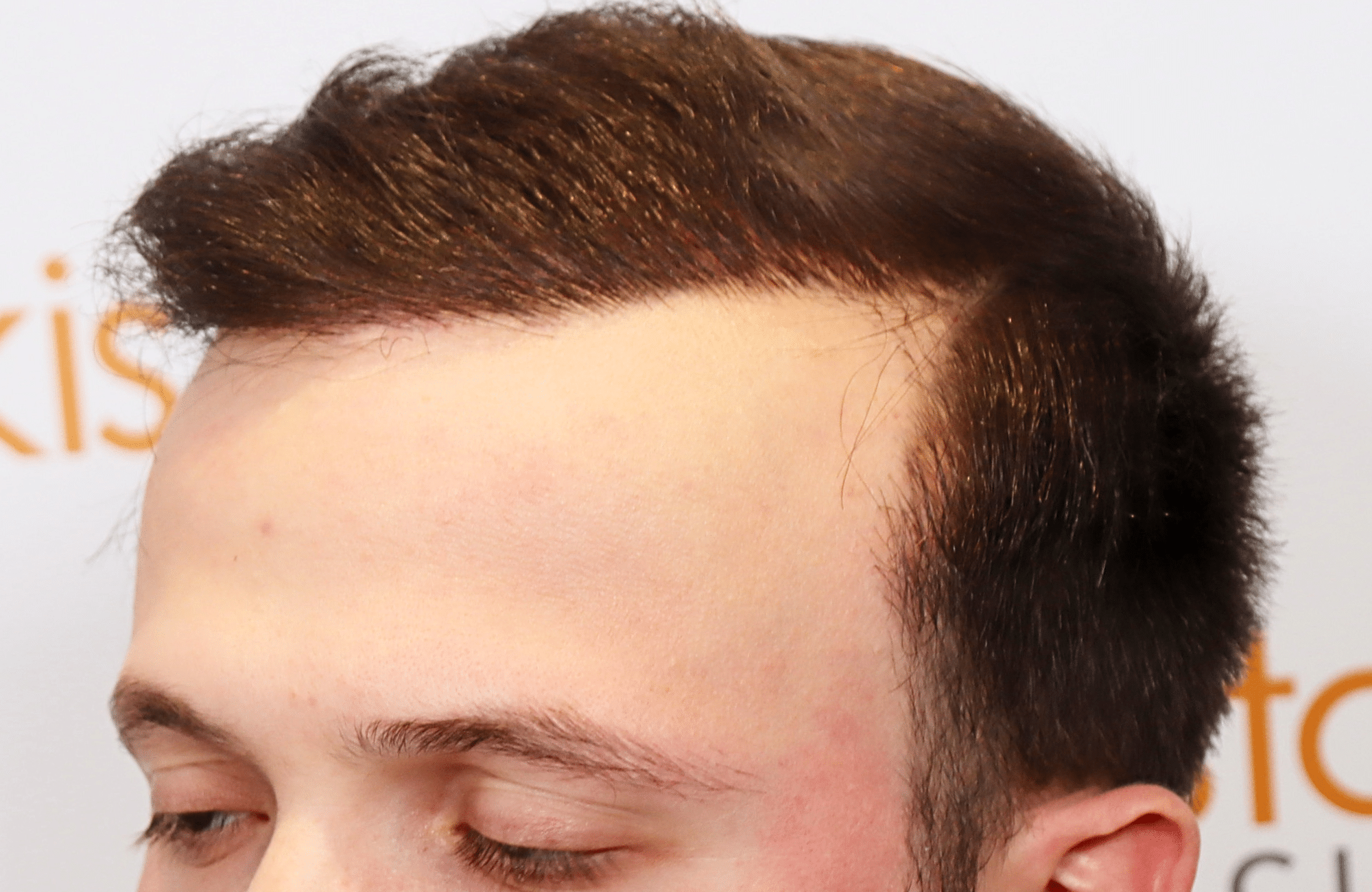 hair trensplant result 3500 fus 30 yr frontal