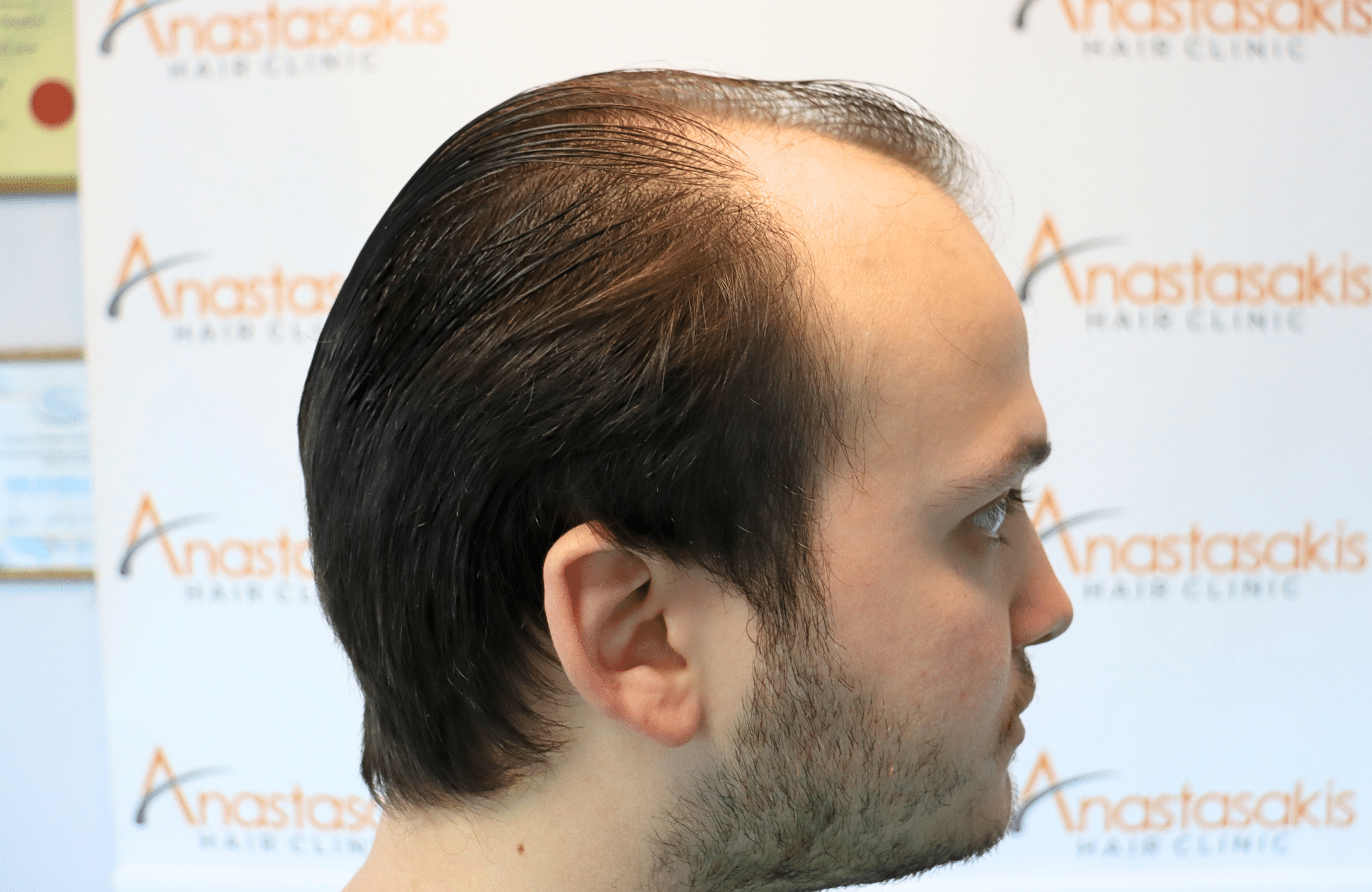 hair trensplant result 3500 fus 30 yr frontal