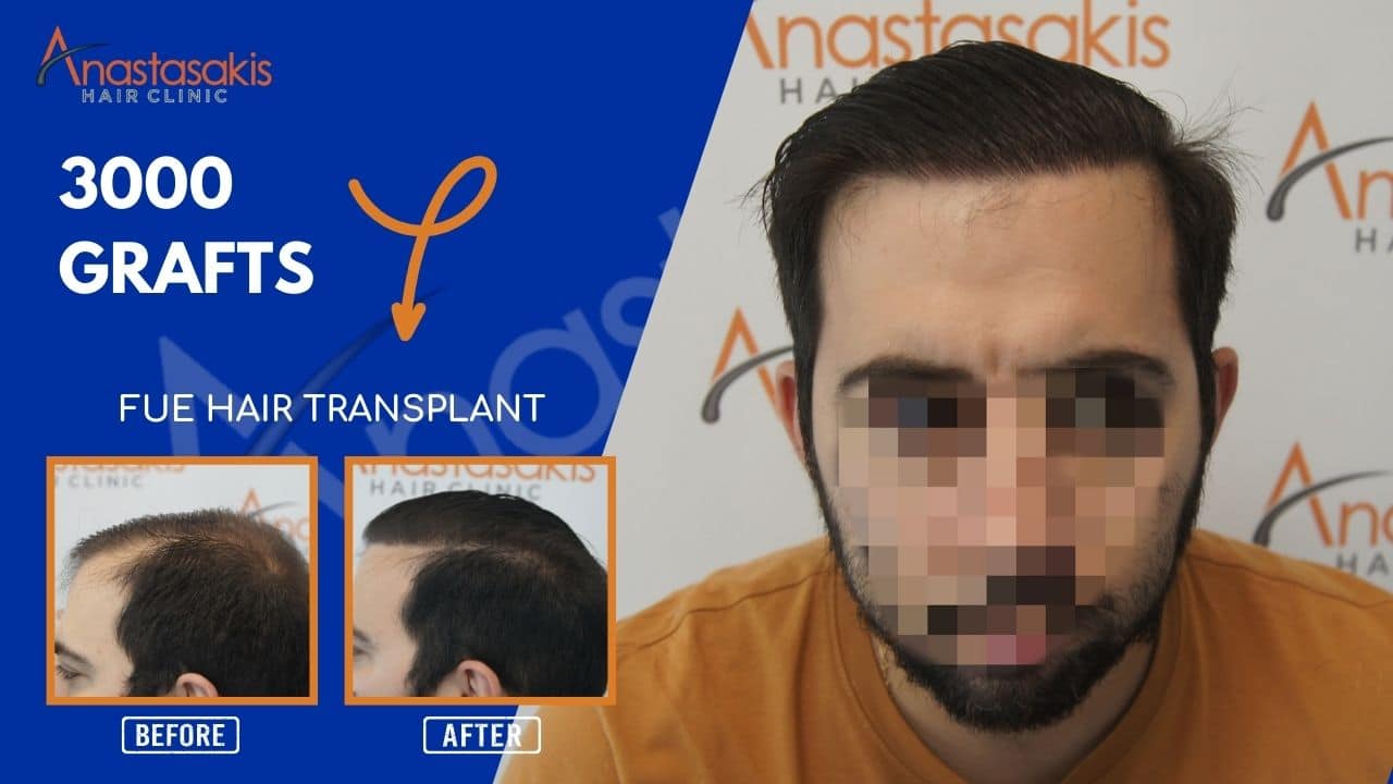 hair transplant result with 3500 follicular units anastasakis hair clinic