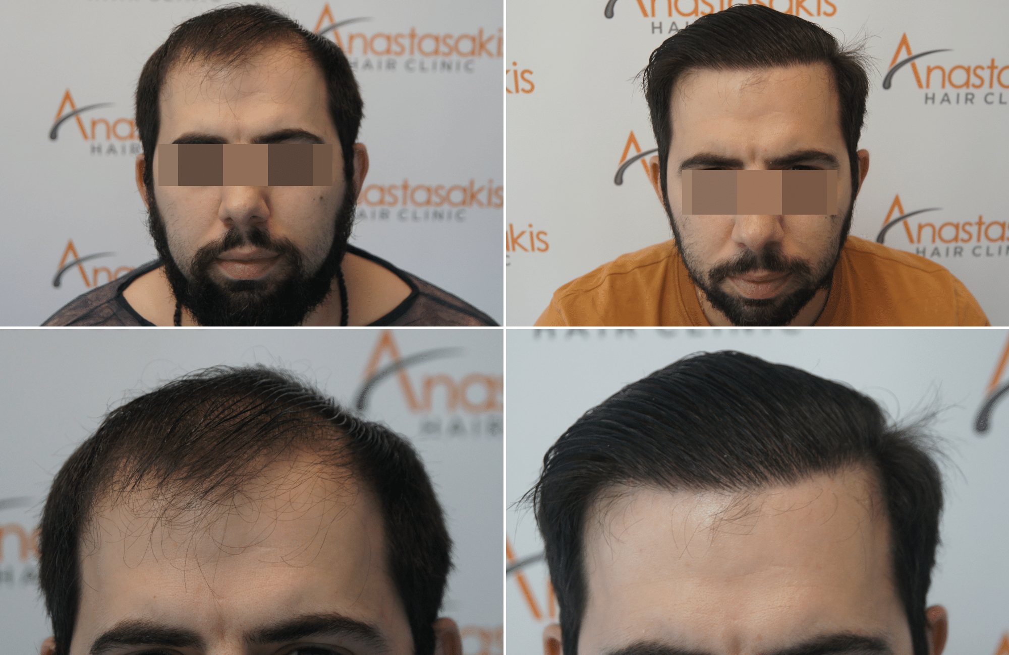 hair transplant result with 3500 follicular units anastasakis hair clinic