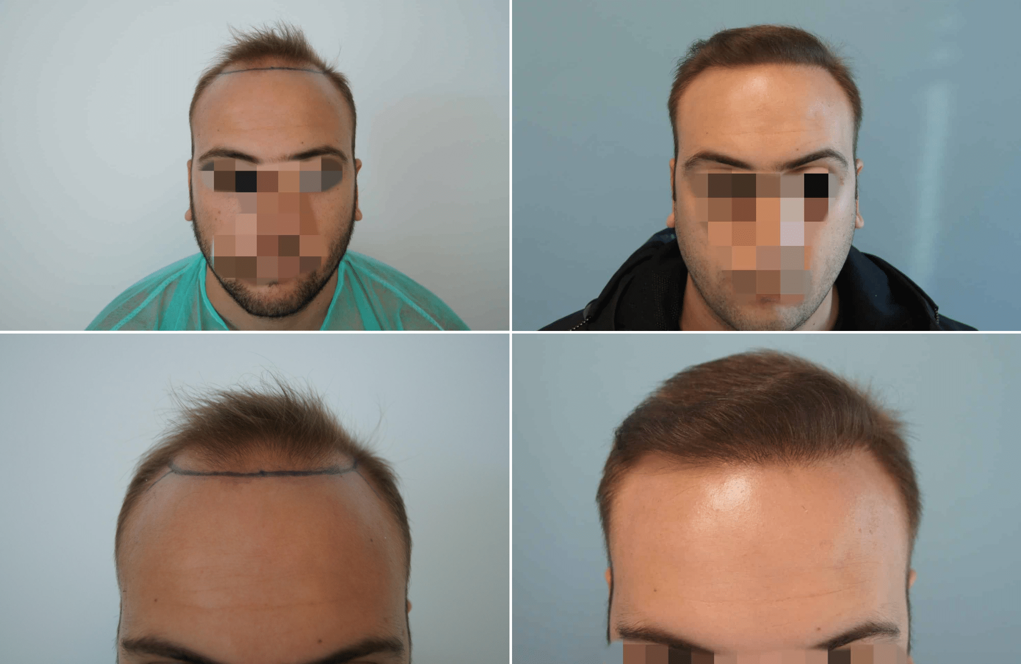 https://www.anastasakishairclinic.gr/portfolio/apotelesma-metamosxefsis-mallion-anastasakis-hair-clinic-109/