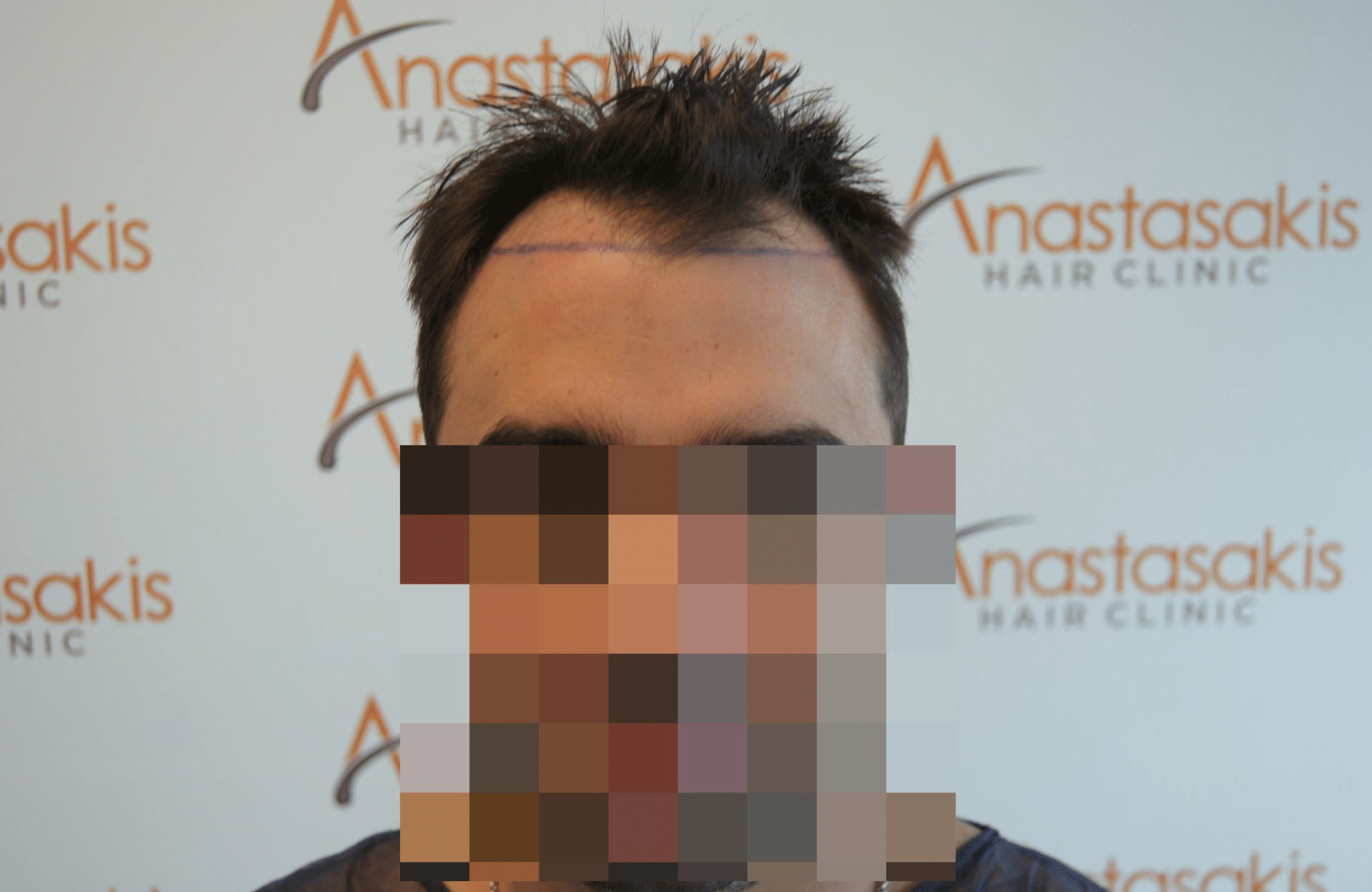 peristatiko prin ti metamosxefsi mallion me 2200 fus fullface
