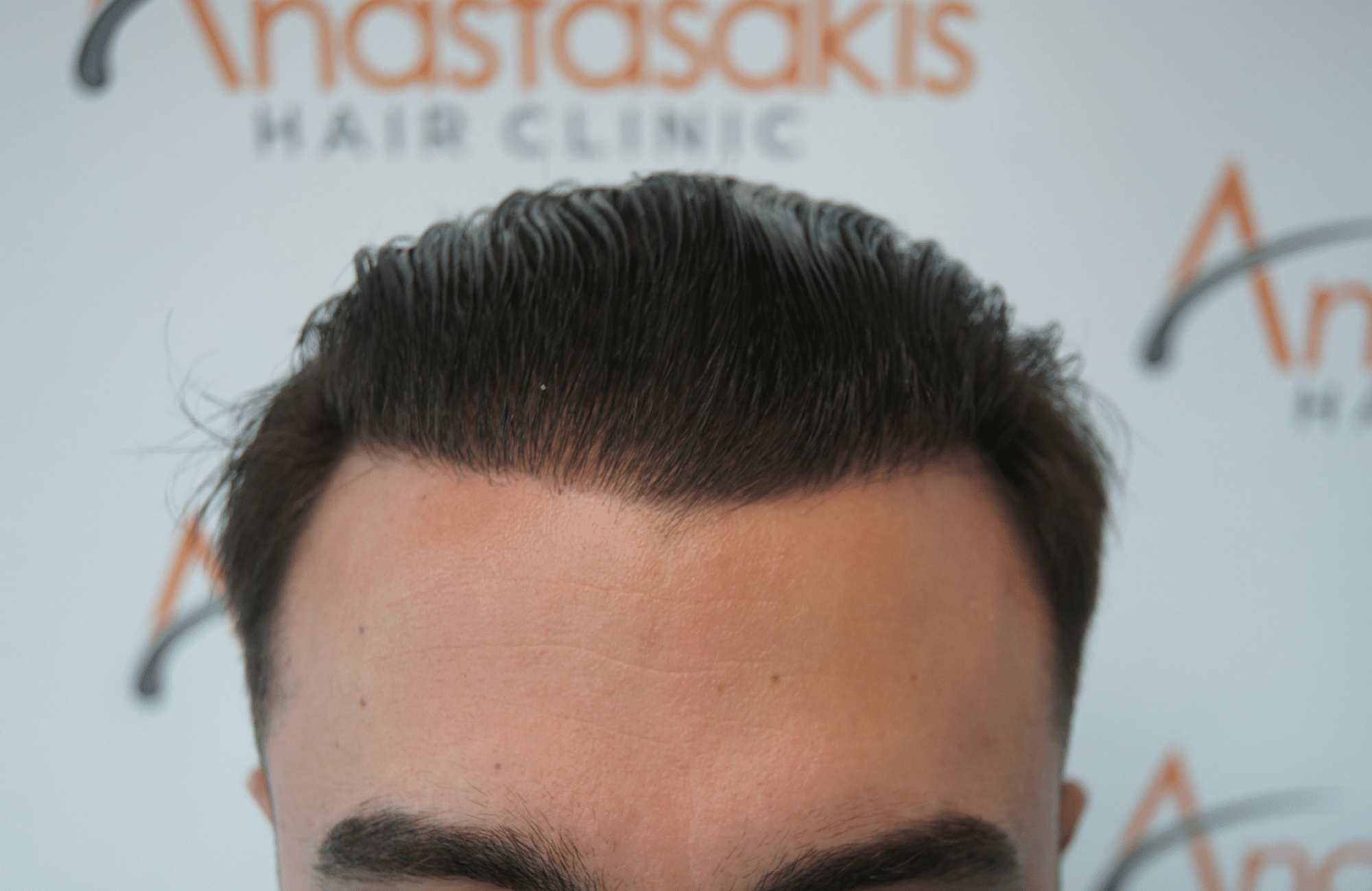peristatiko meta ti metamosxefsi mallion me 2200 fus fullface wet hair