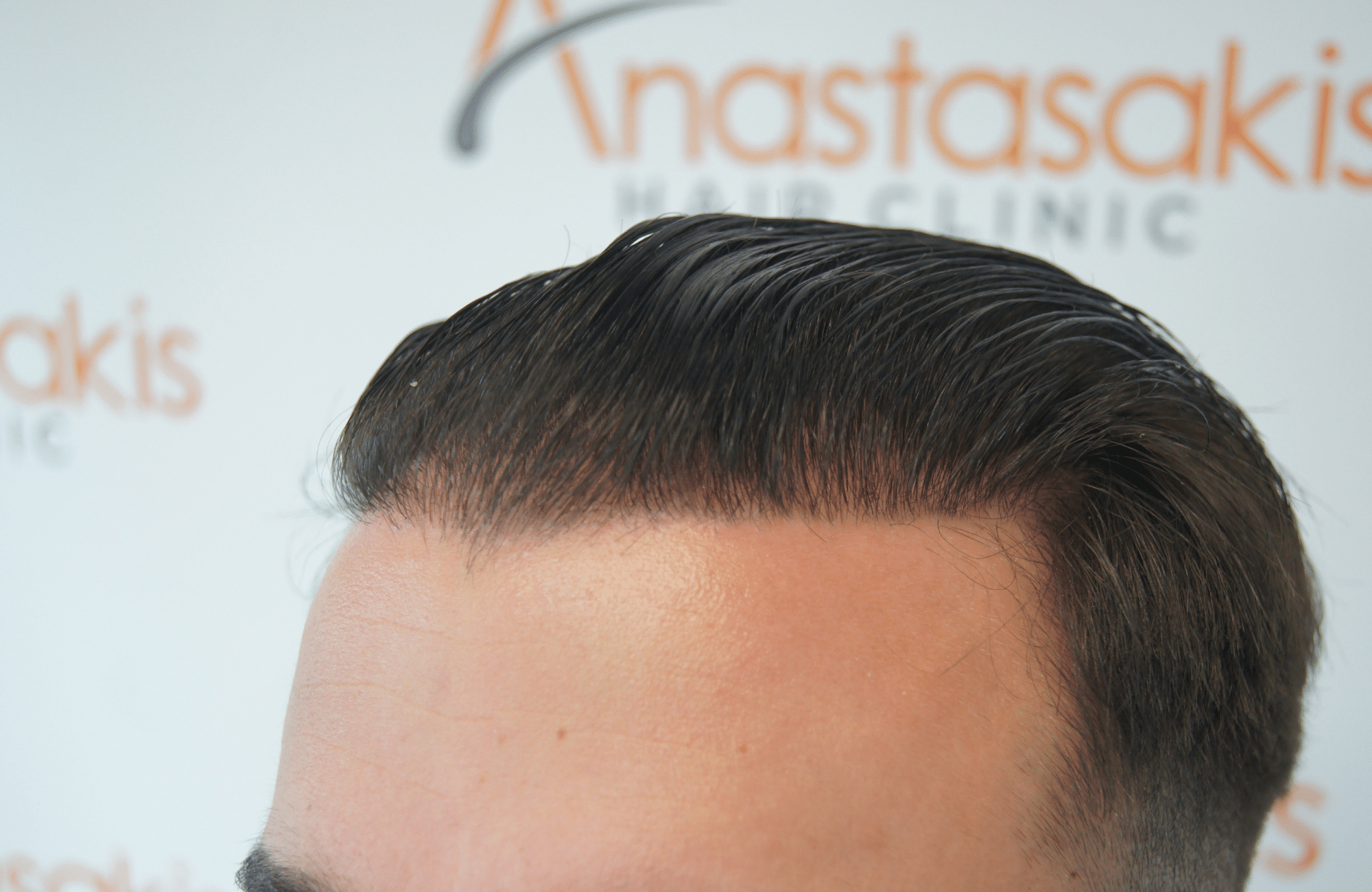 peristatiko meta ti metamosxefsi mallion me 2200 fus side2 wet hair