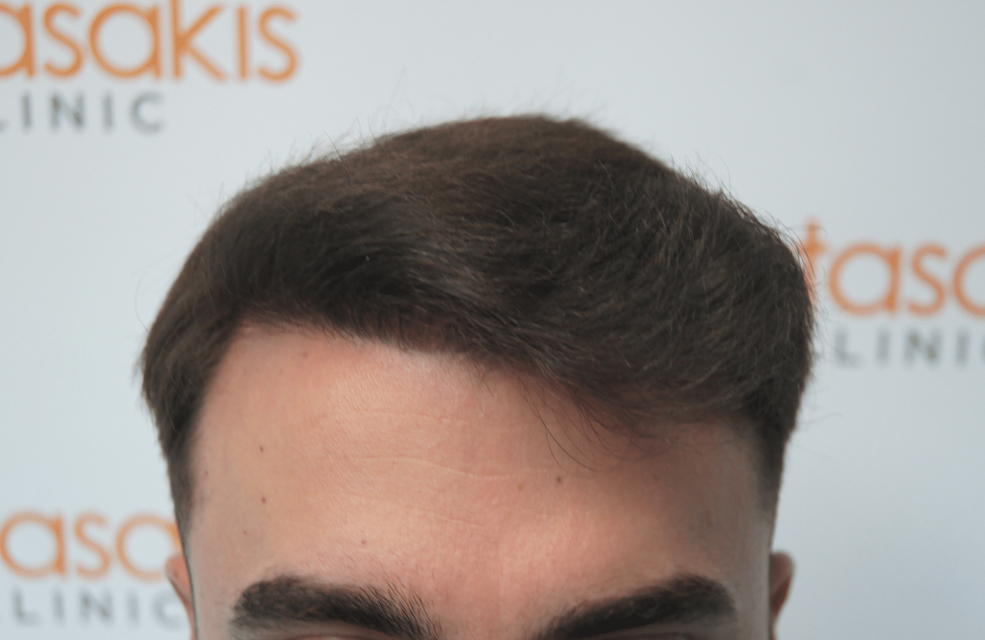 peristatiko meta ti metamosxefsi mallion me 2200 fus hairline