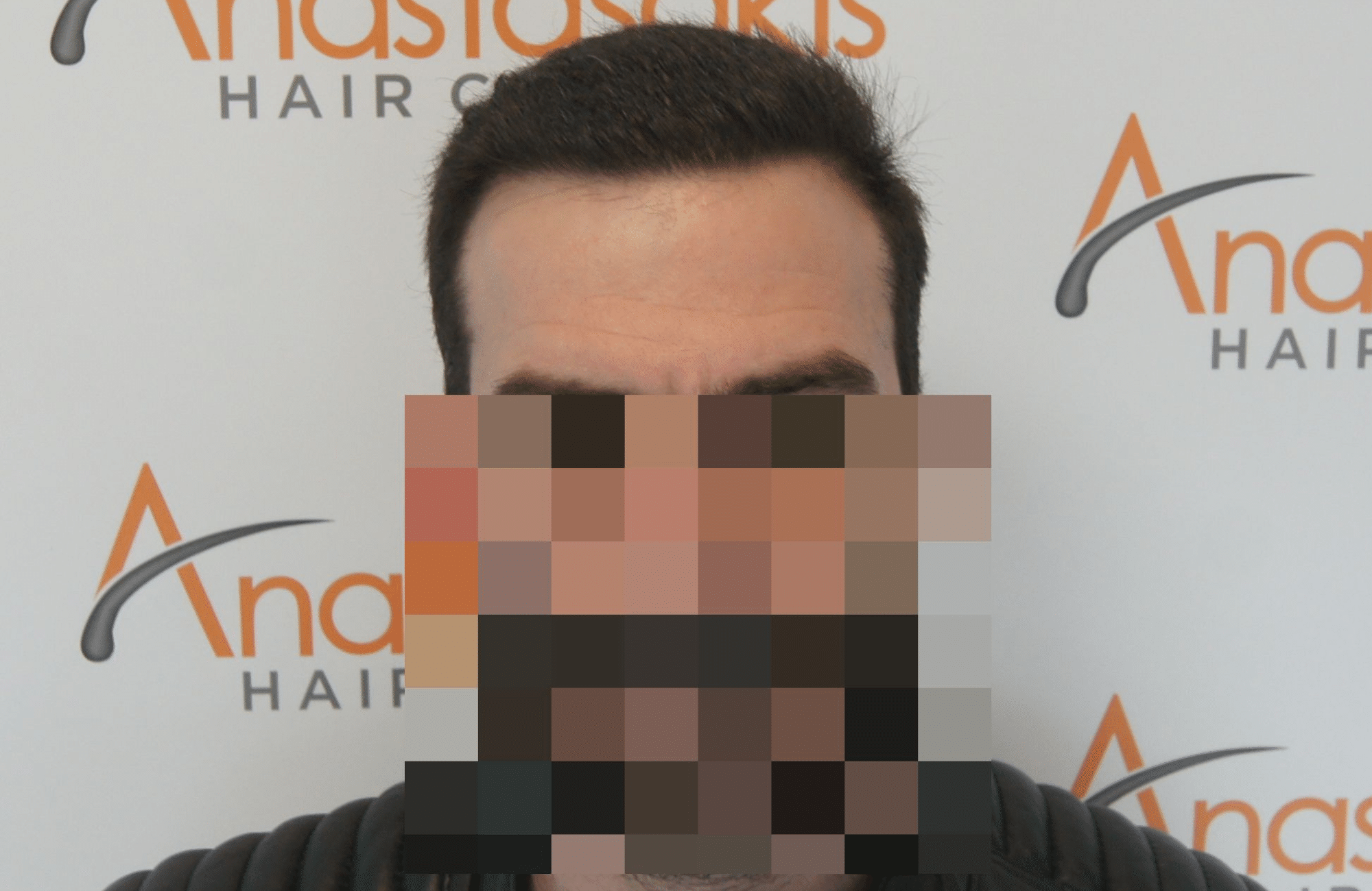 hair transplant with 2500 fus fue after - fullface