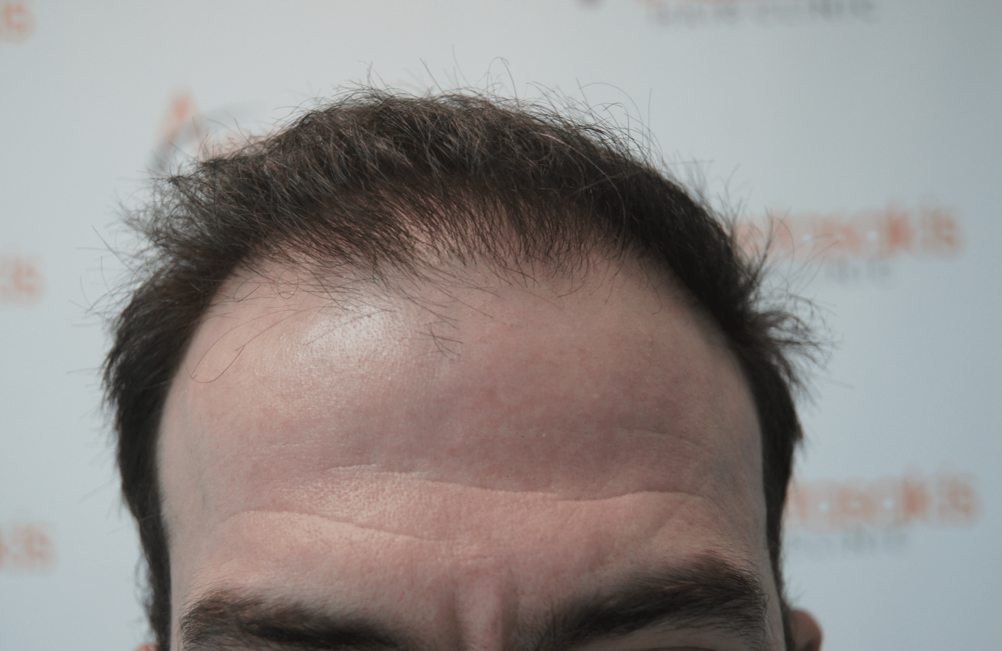 hair transplant with 2500 fus fue before - hairline